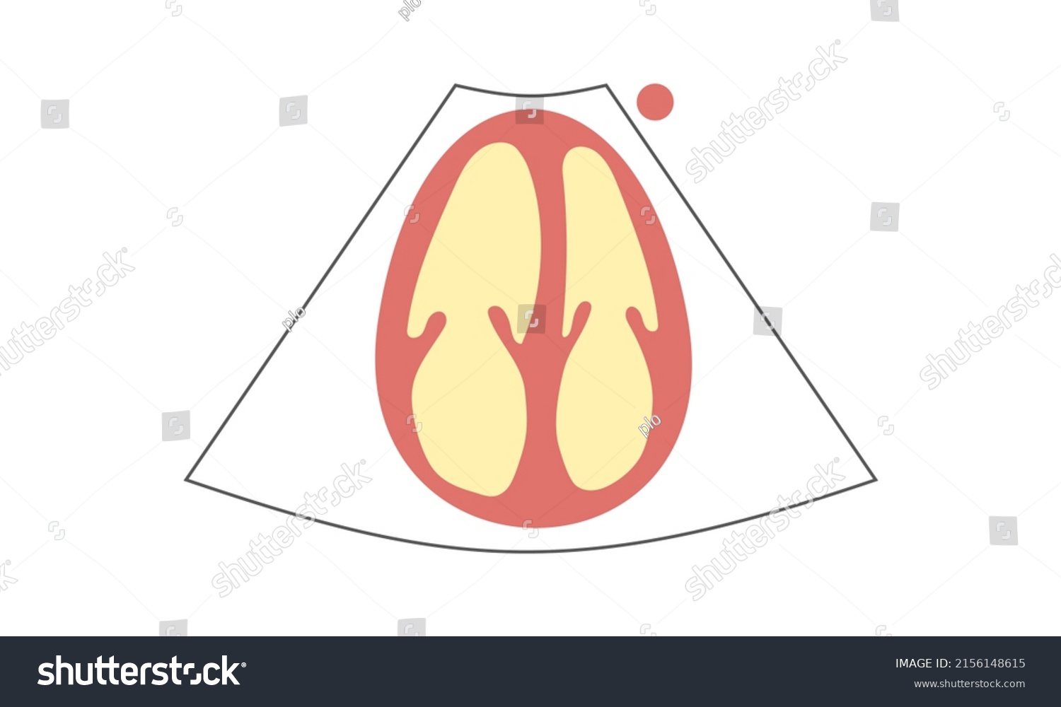 SVG of Diagram of right Ventricle enlargement of Apical 4-Chamber View of Echocardiography. Healthcare Concept svg