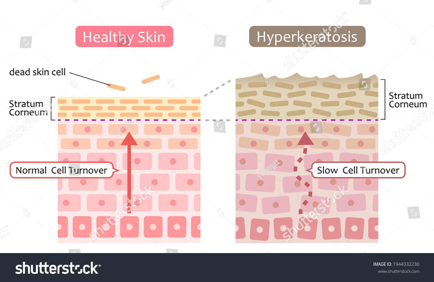 Diagram Skin Cell Turnover Thickening Stratum Stock Vector (Royalty ...