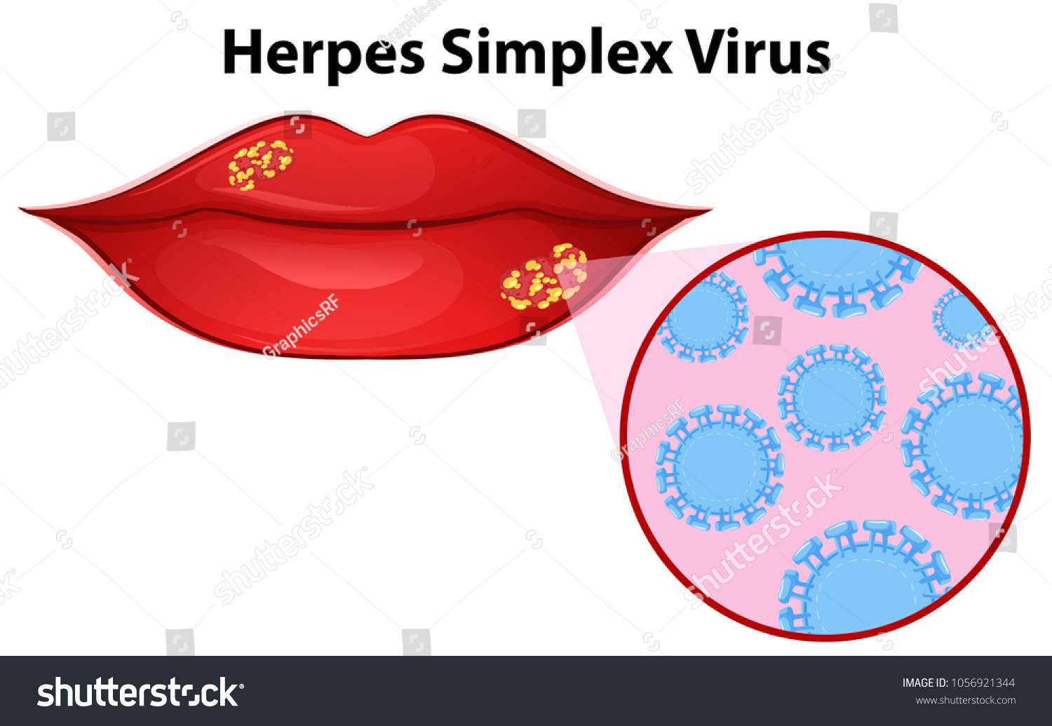 Diagram Showing Herpes Simplex Virus Illustration Stock Vector Royalty Free 1056921344