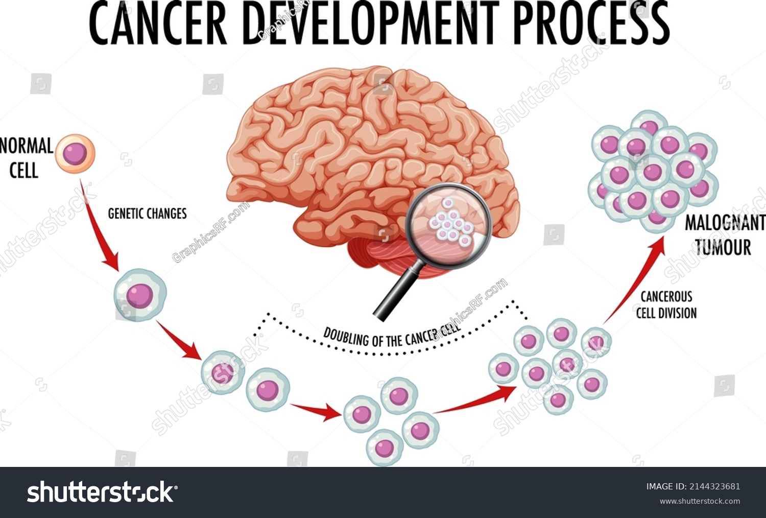 Diagram Showing Human Brain Cancer Illustration Stock Vector (Royalty ...