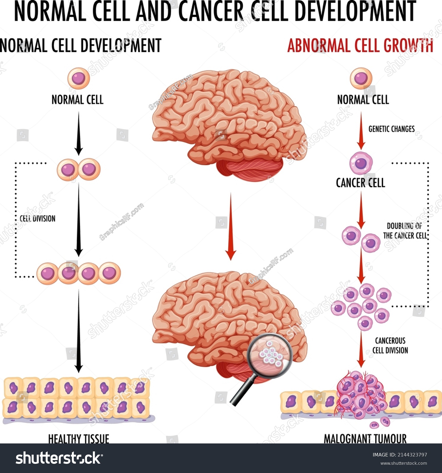 Diagram Showing Human Brain Cancer Illustration Stock Vector (Royalty ...