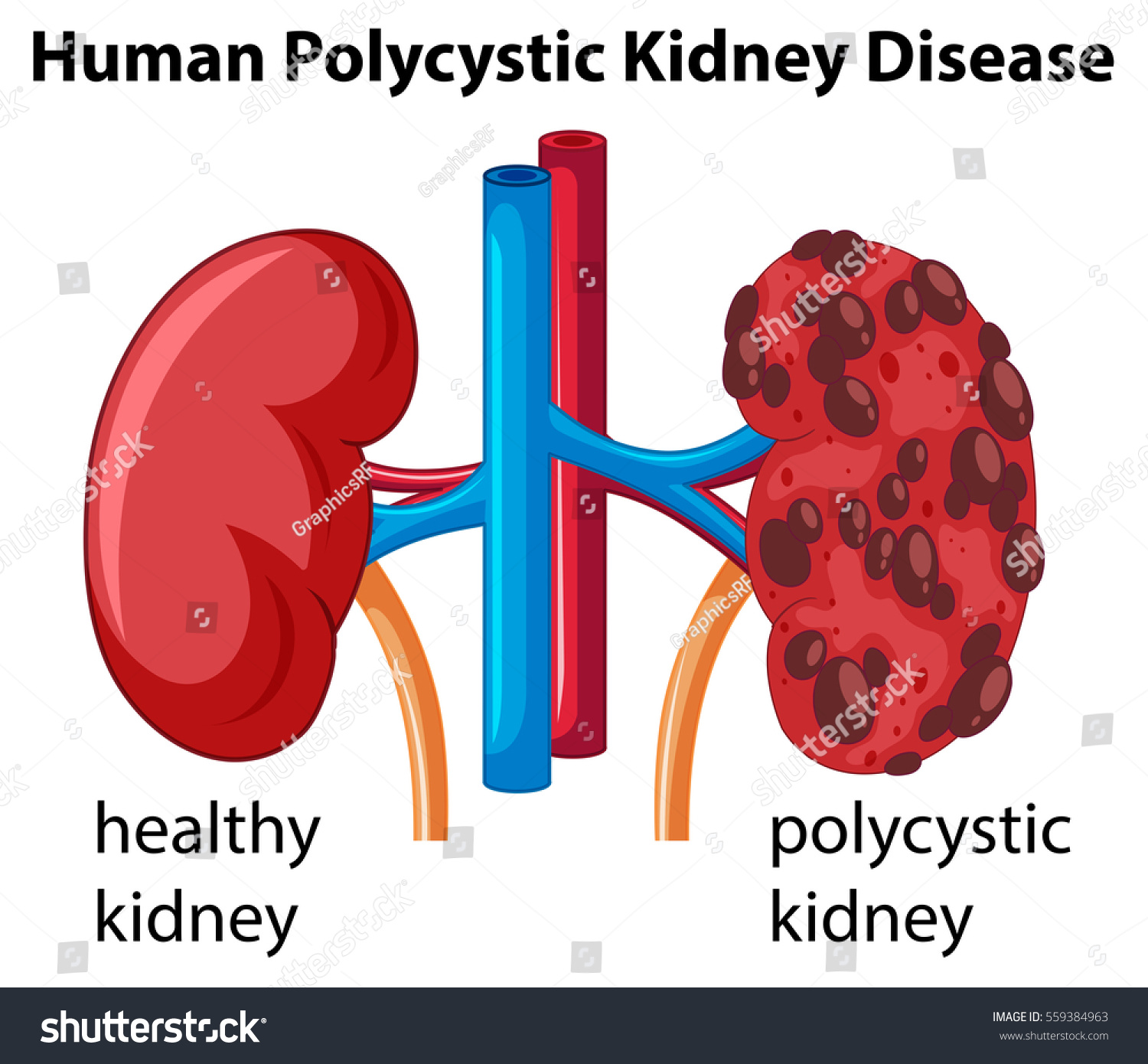 593 Polycystic kidney Images, Stock Photos & Vectors | Shutterstock