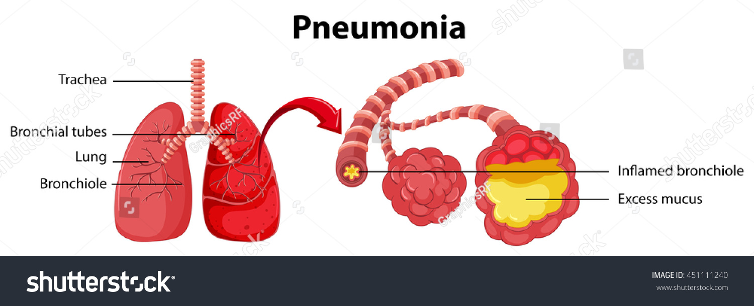 Diagram Showing Lung With Pneumonia Royalty Free Vector 9DD