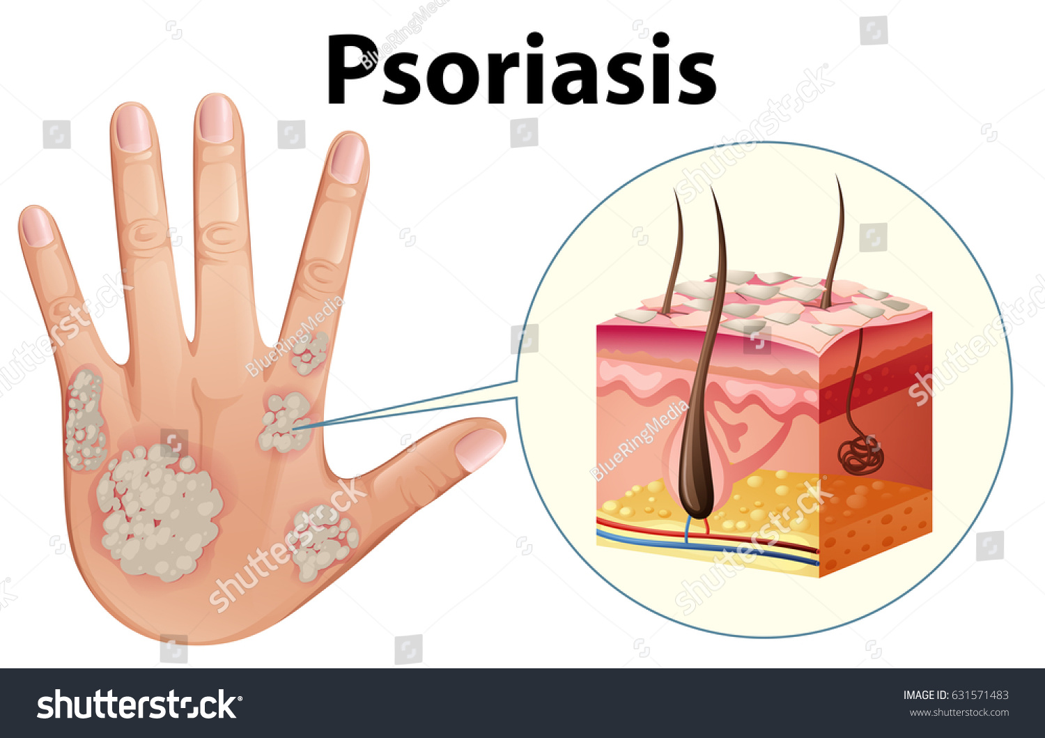 Diagram Showing Psoriasis On Human Hand Stock Vector 631571483