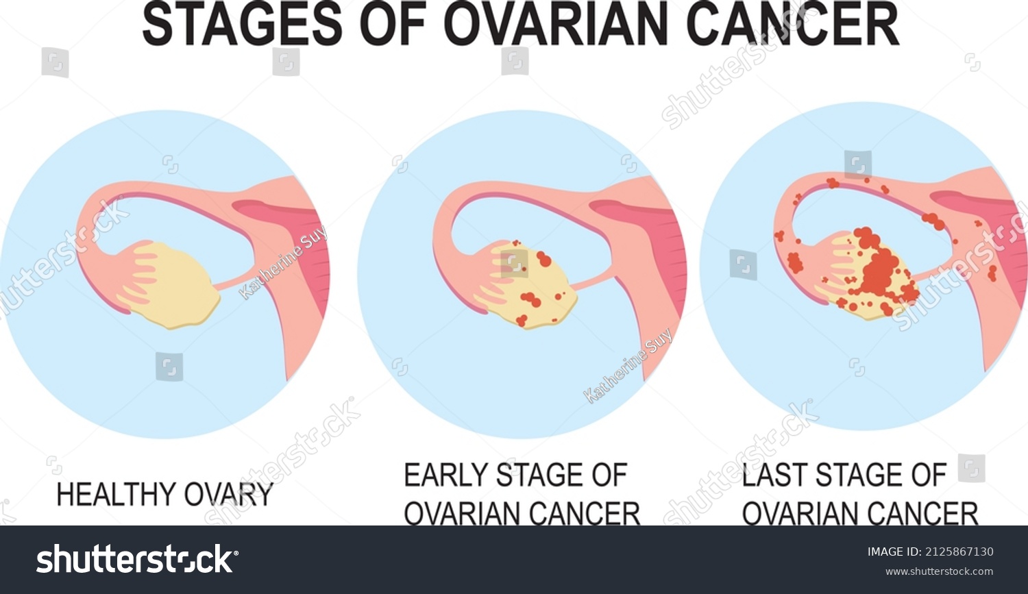 Diagram Showing Stages Ovarian Cancer Illustration Stock Vector ...