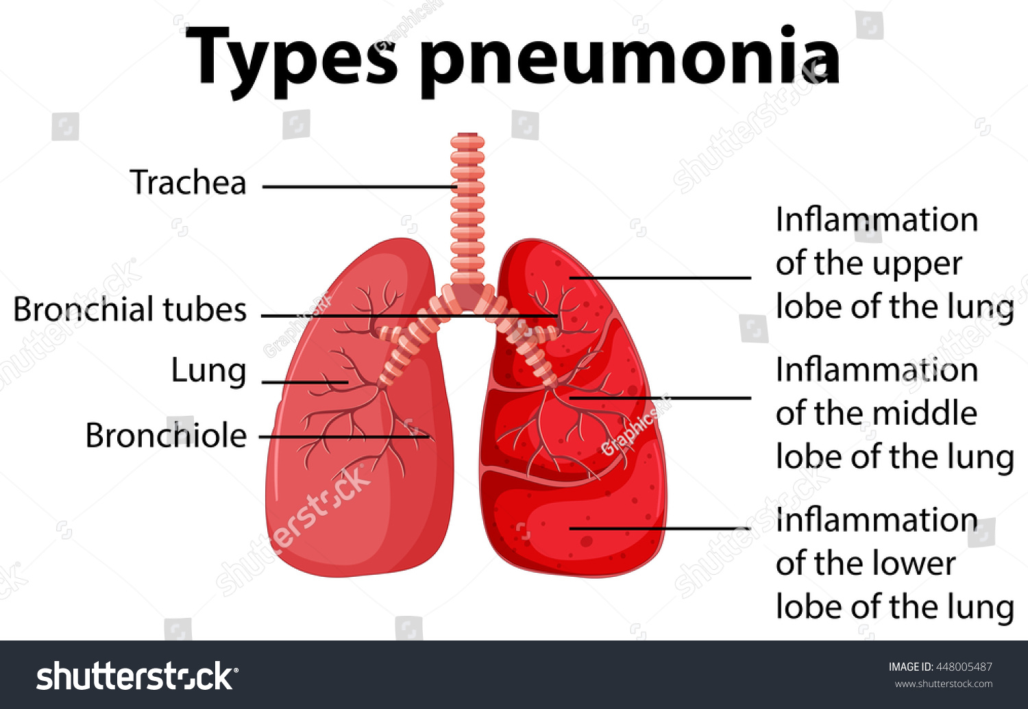 Vektor Stok Diagram Showing Types Pneumonia Illustration Tanpa Royalti   Stock Vector Diagram Showing Types Pneumonia Illustration 448005487 