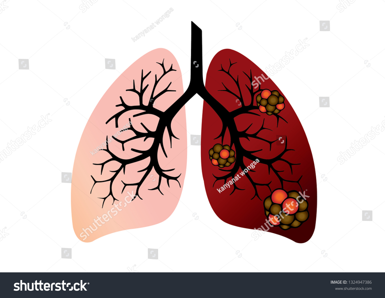 Difference Between Human Normal Lungs Lungs Stock Vector (Royalty Free ...