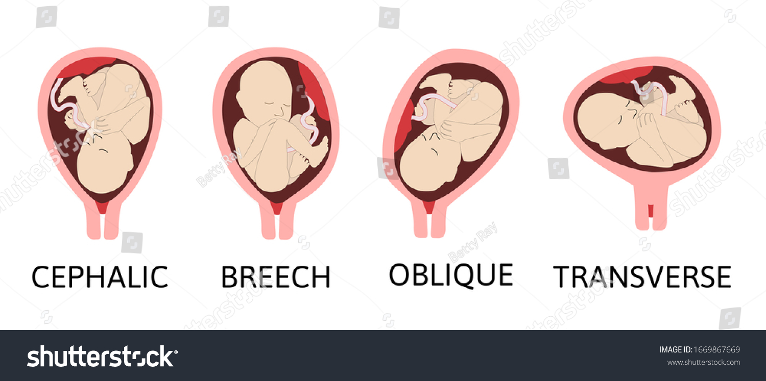 Differentes Positions De Bebe Dans L Uterus Image Vectorielle De Stock Libre De Droits