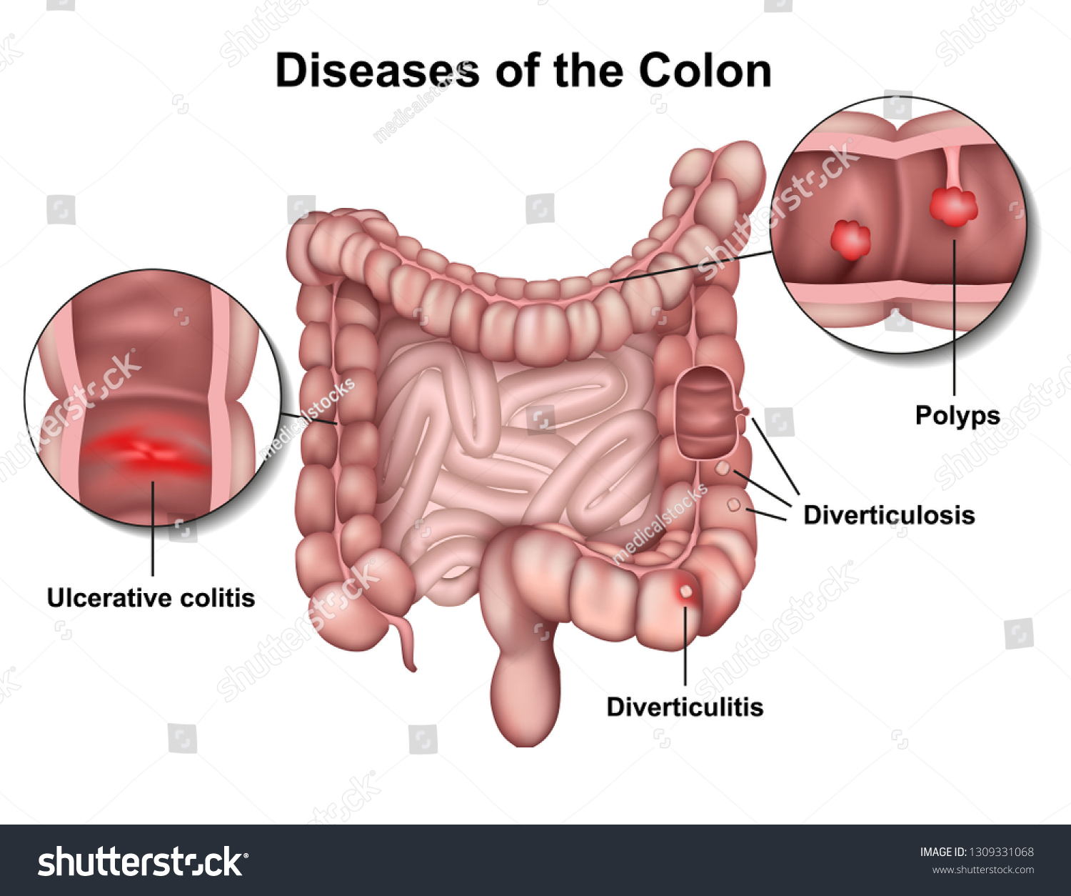 Stock Vektor Diseases Colon 3d Medical Vector Illustration Bez Autorskych Poplatku 1309331068