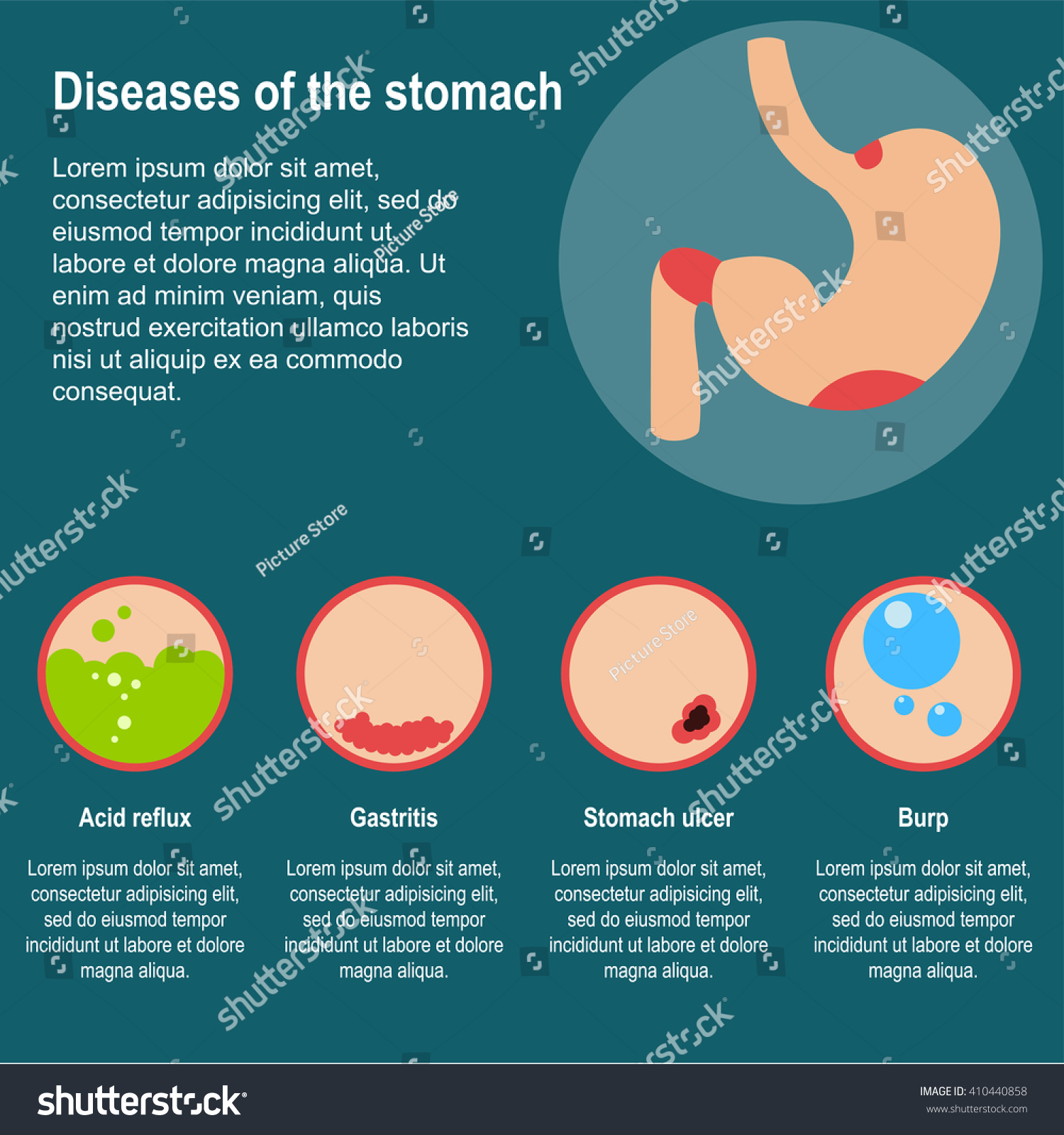 Diseases Of The Stomach. Vector Illustration Damage To The Stomach ...