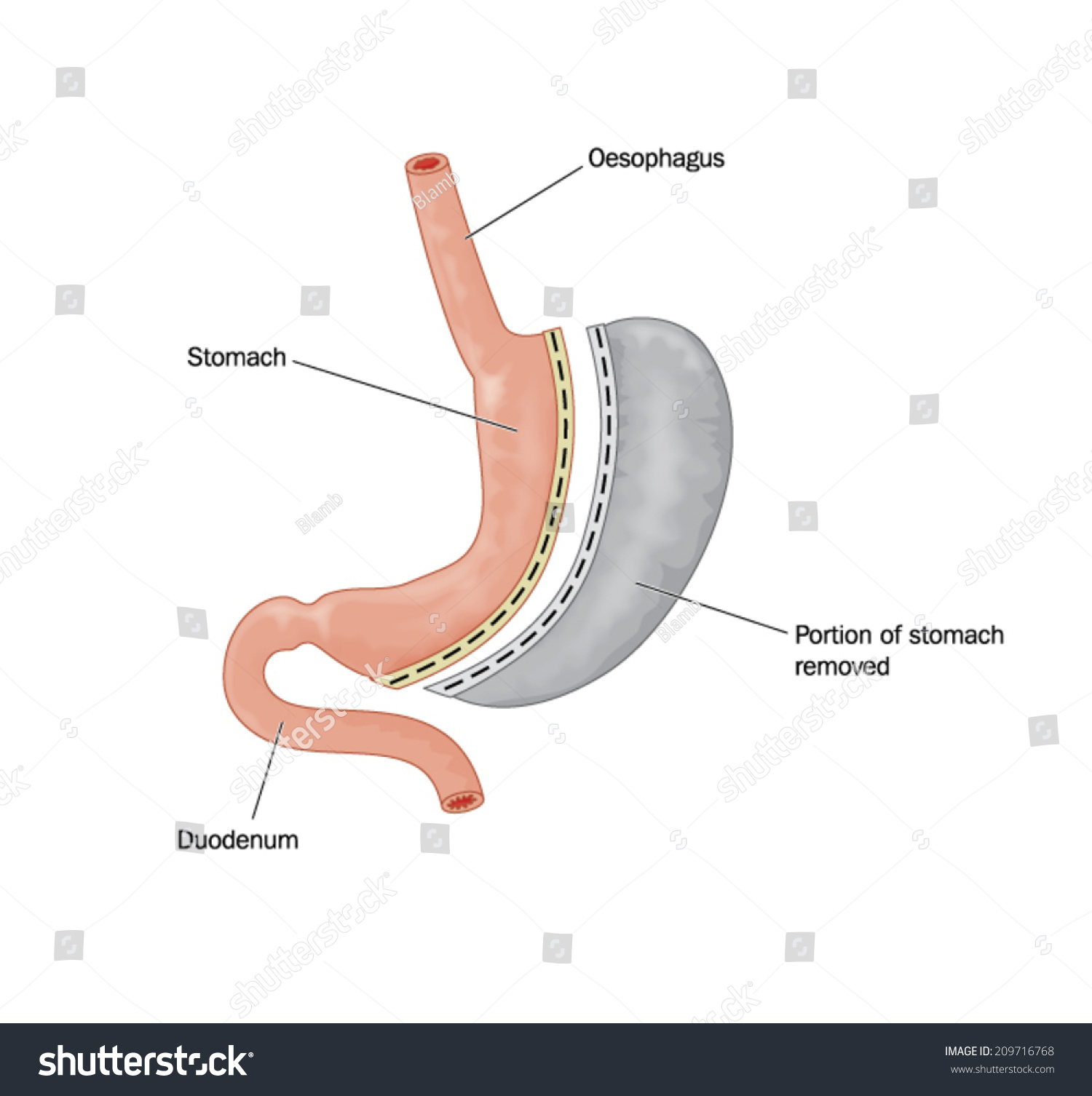 Drawing Of Bariatric Surgery, Showing Half The Stomach Removed And The ...