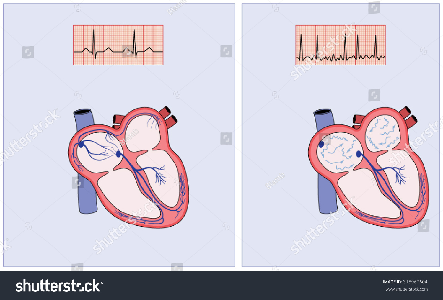 Drawing Of The Heart Electrical Conduction System Showing Normal ...