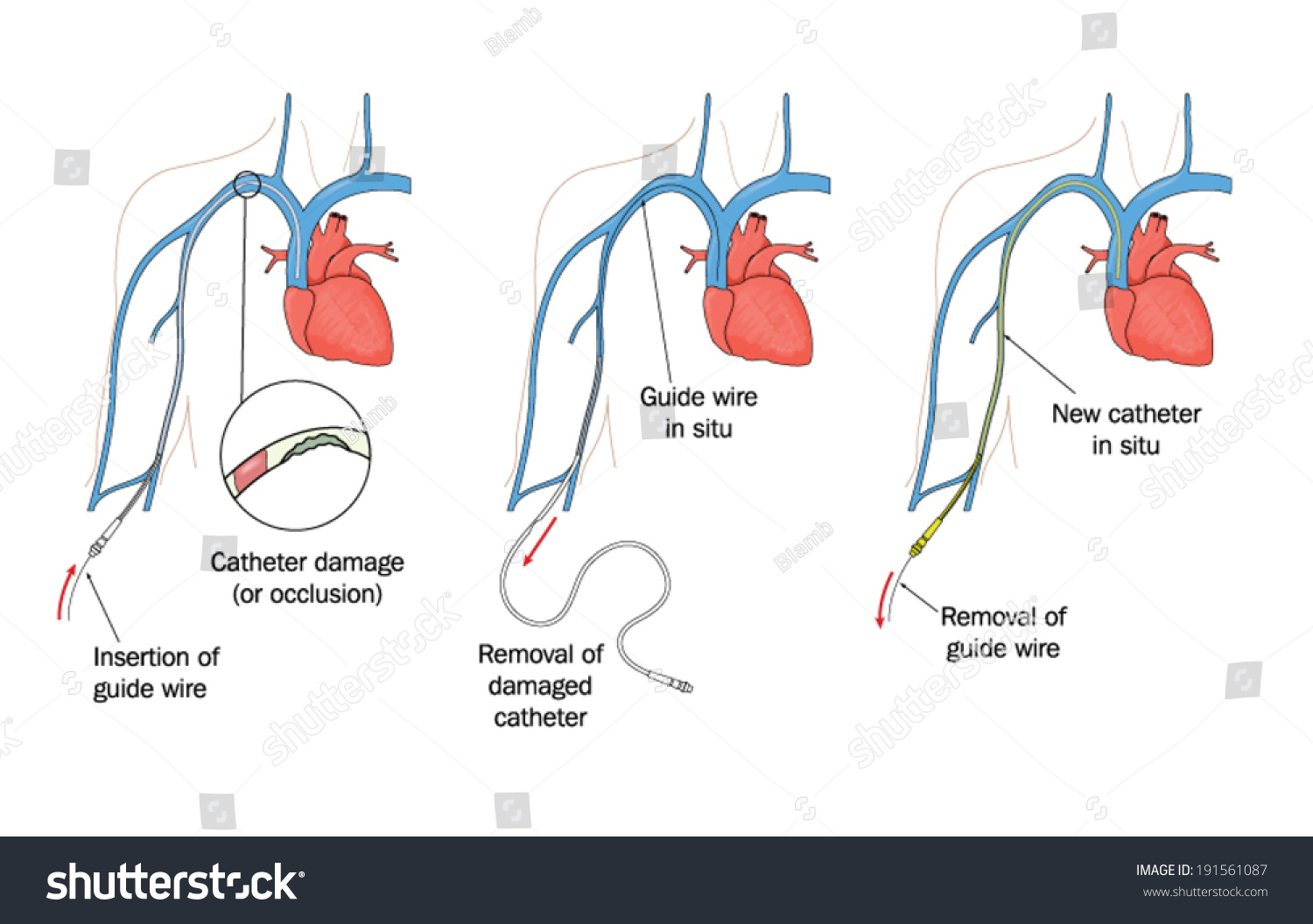 Drawing Show Replacement Damaged Peripherally Inserted Stock Vector ...