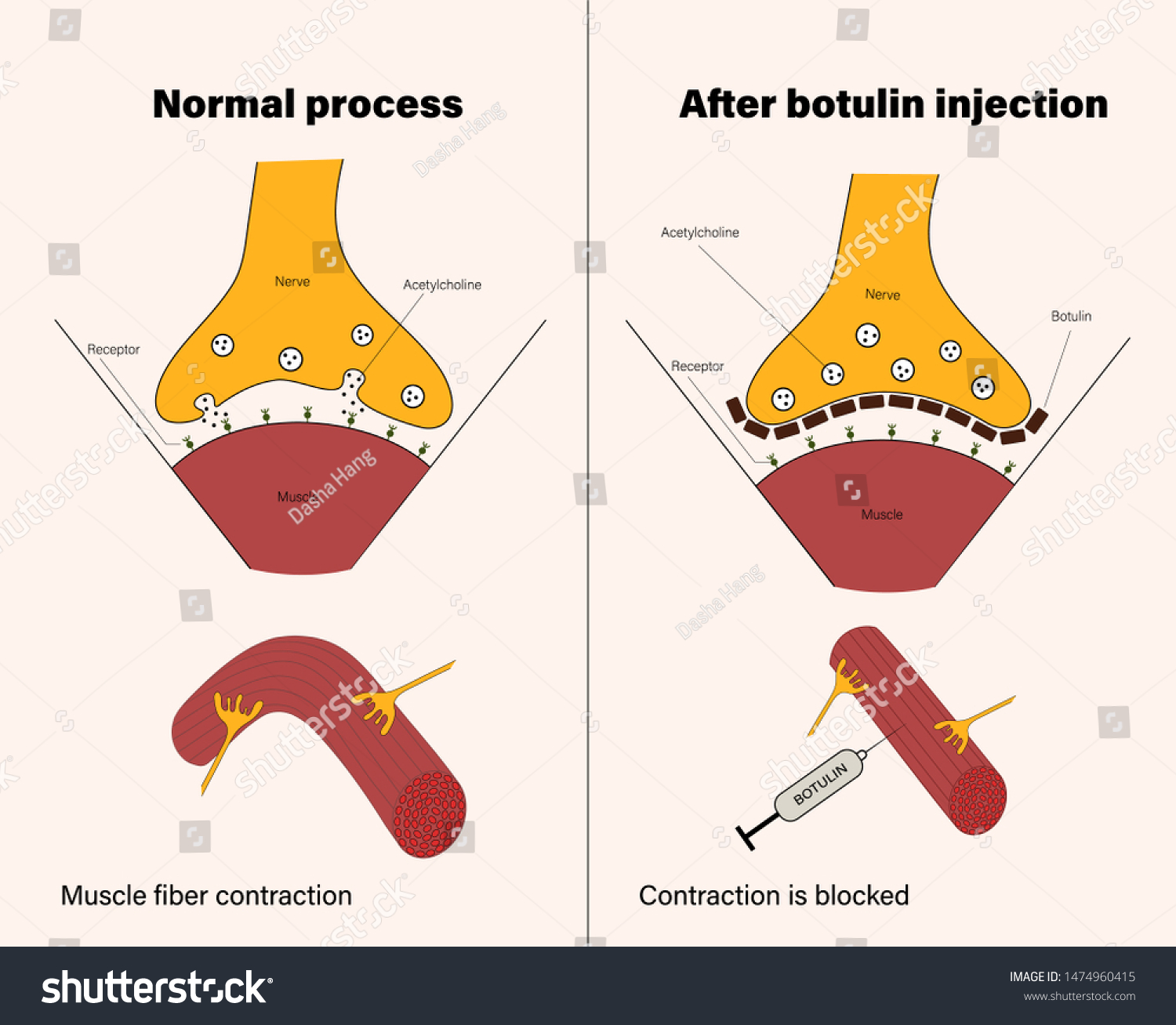 Drug Made Botulin Botulinum Toxin Produced Stock Vector Royalty Free 1474960415