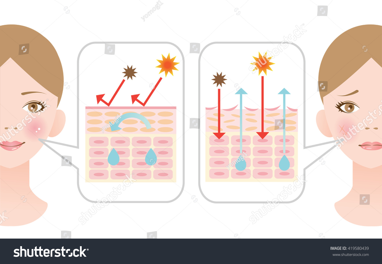 Dry Skin And Healthy Skin Stock Vector Illustration 419580439 ...