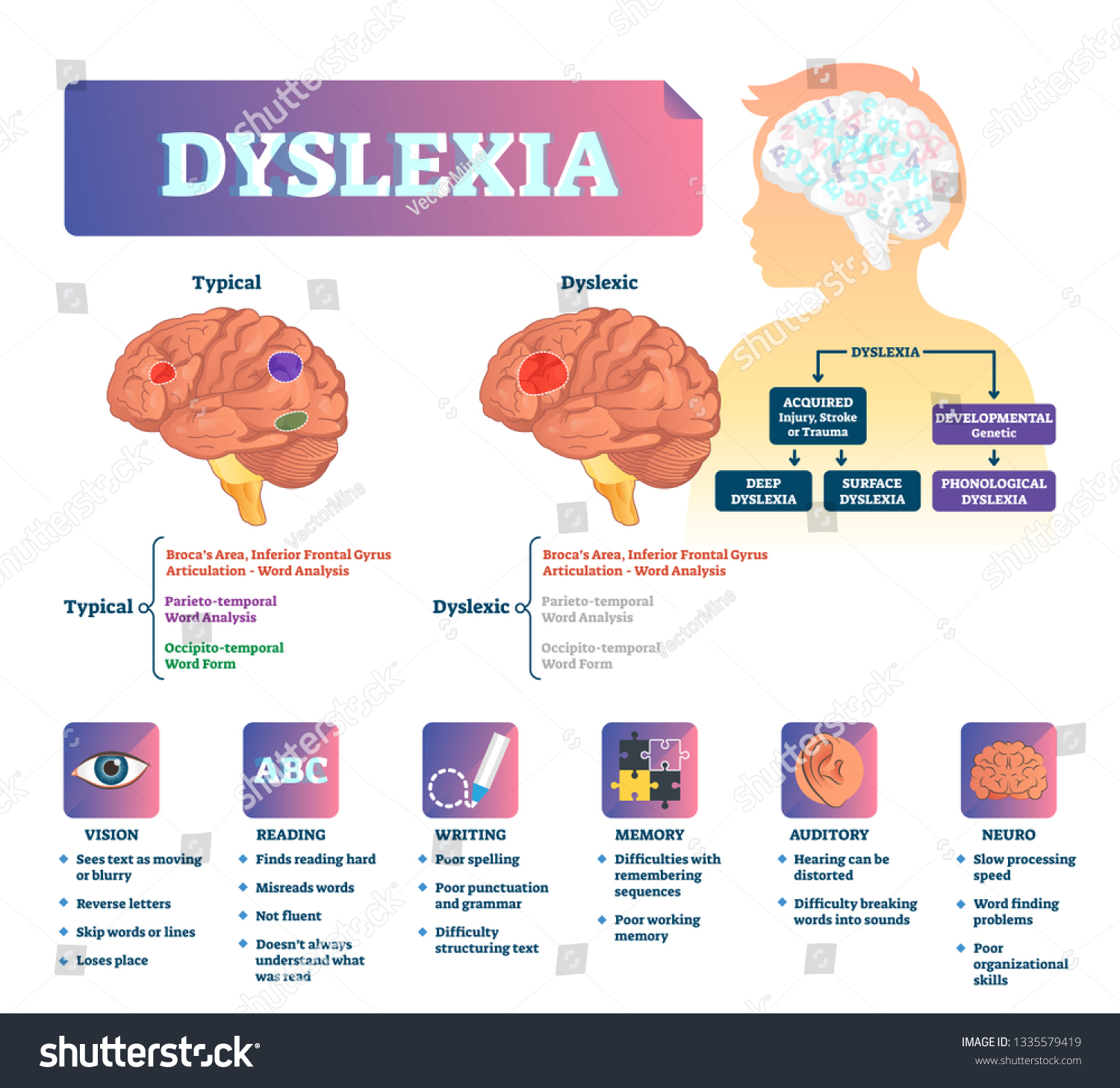 Dyslexia Vector Illustration Labeled Medical Brain: Vector Có Sẵn (miễn ...