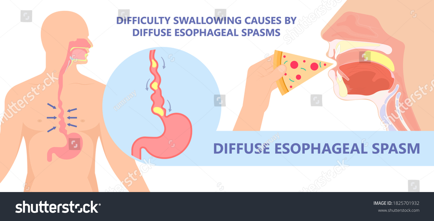 dysphagia-infection-trachea-examine-surgery-choking-stock-vector