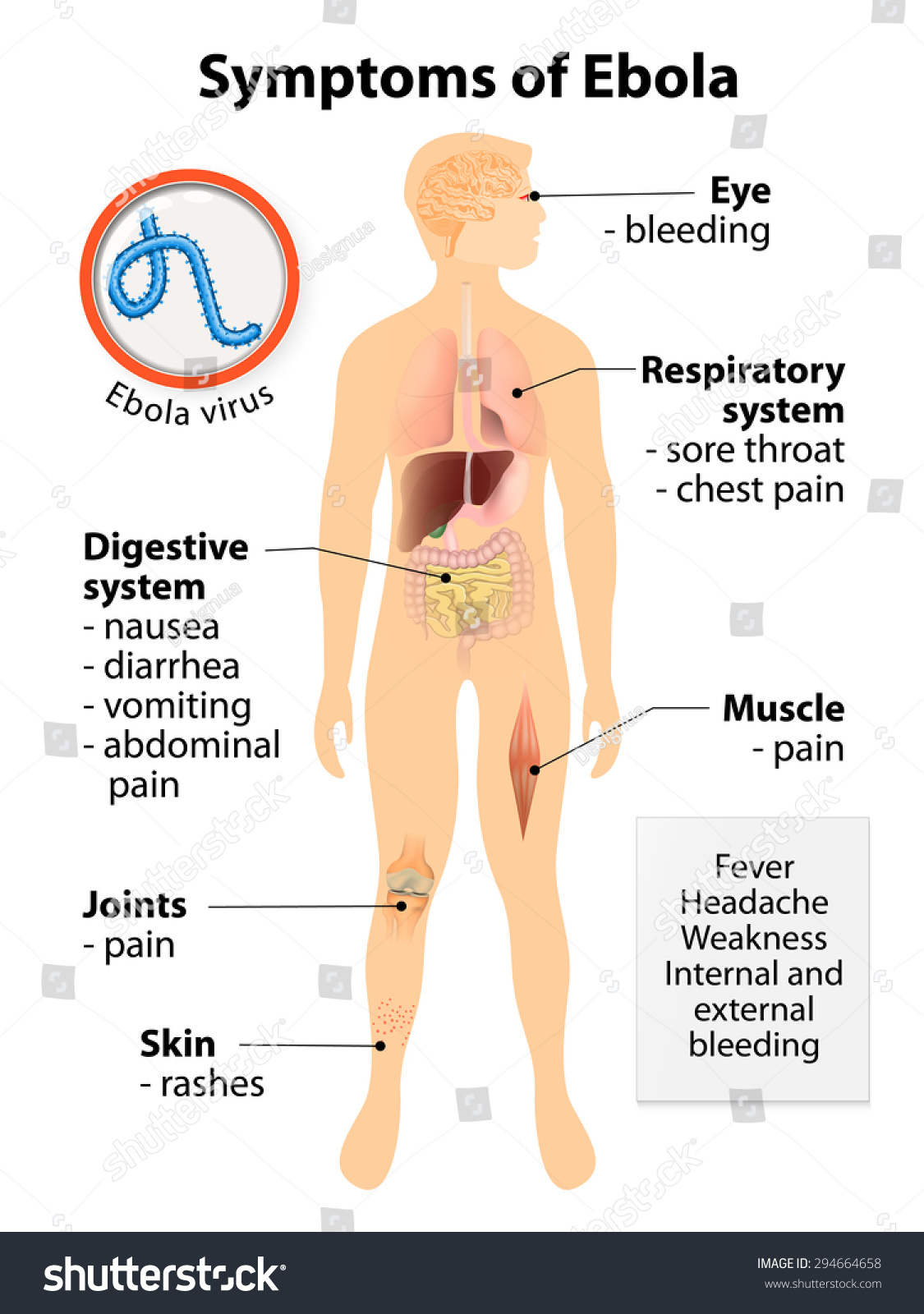 the symptoms of ebola virus an infectious disease They are also easily confused with symptoms of other infectious diseases that cause a high fever people with a history of ebola virus infection are deferred. the symptoms of ebola virus an infectious disease They are also easily confused with symptoms of other infectious diseases that cause a high fever people with a history of ebola virus infection are deferred.