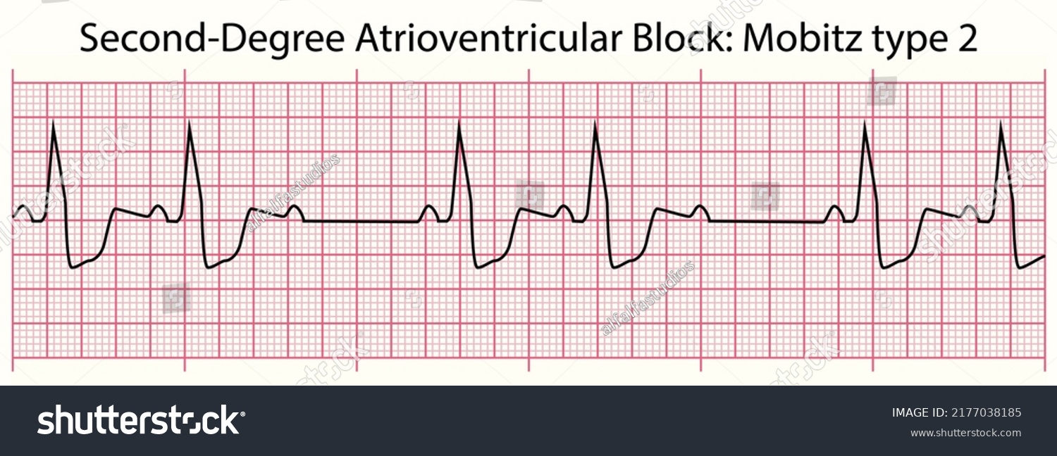 713 Ecg limb Images, Stock Photos & Vectors | Shutterstock