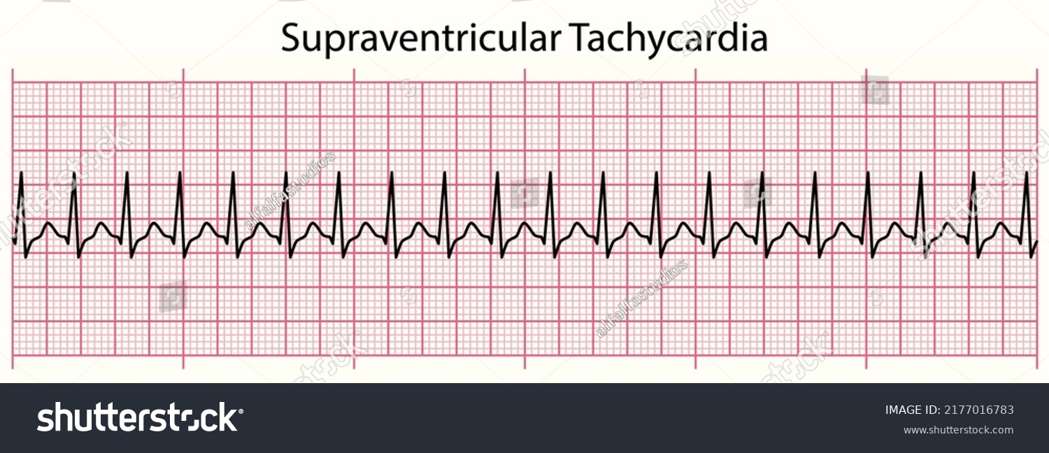 Ecg Line Supraventricular Tachycardia 6 Second Stock Vector (Royalty ...