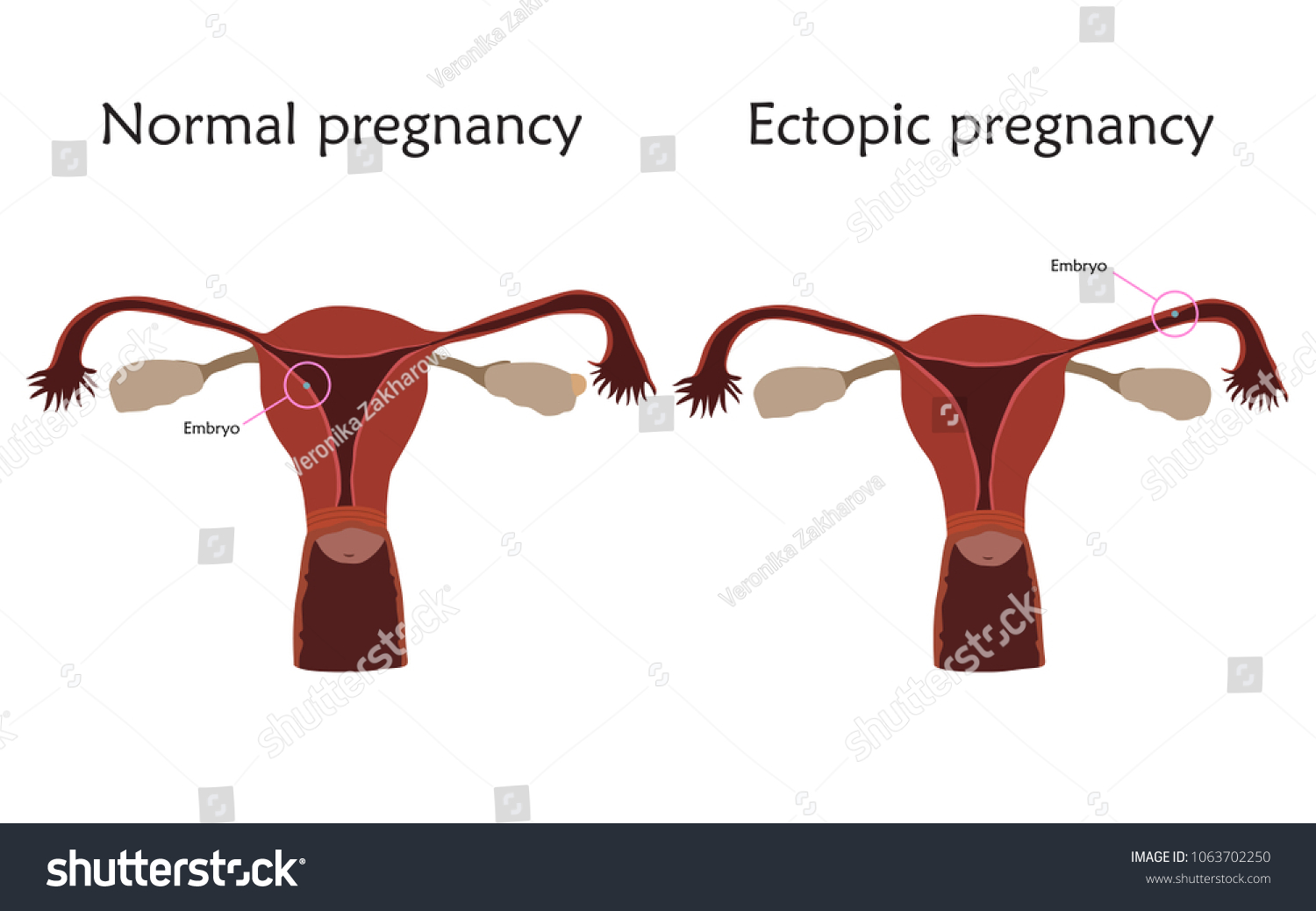 Ectopic Normal Pregnancy Fertilized Egg Uterus Stock Vector (Royalty ...