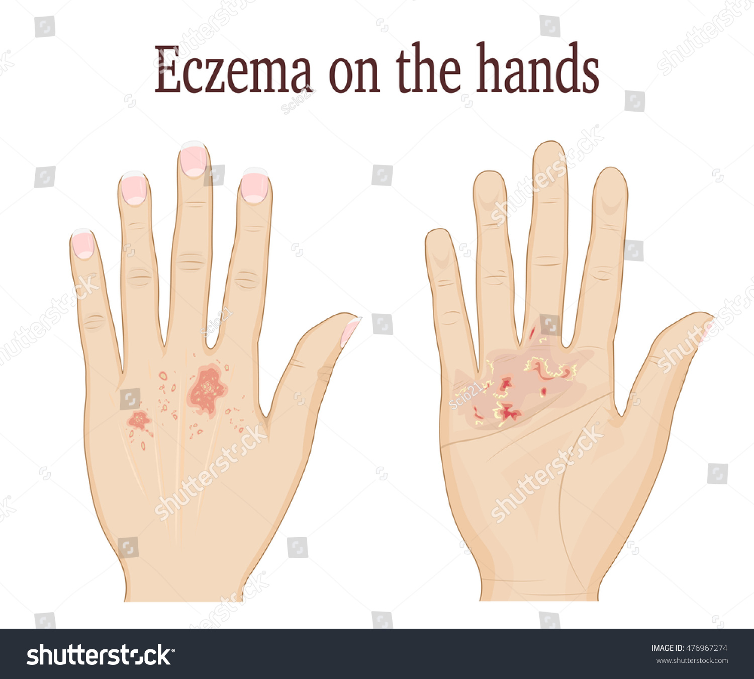 Eczema On Palm On Back Hand Stock Vector 476967274 - Shutterstock