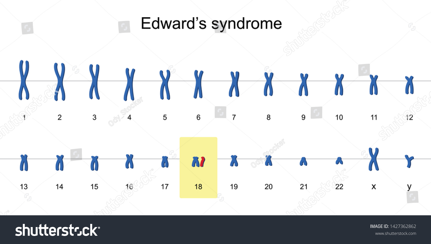 Edwards Syndrome Karyotype Autosomal Abnormalities Trisomy 库存矢量图（免版税