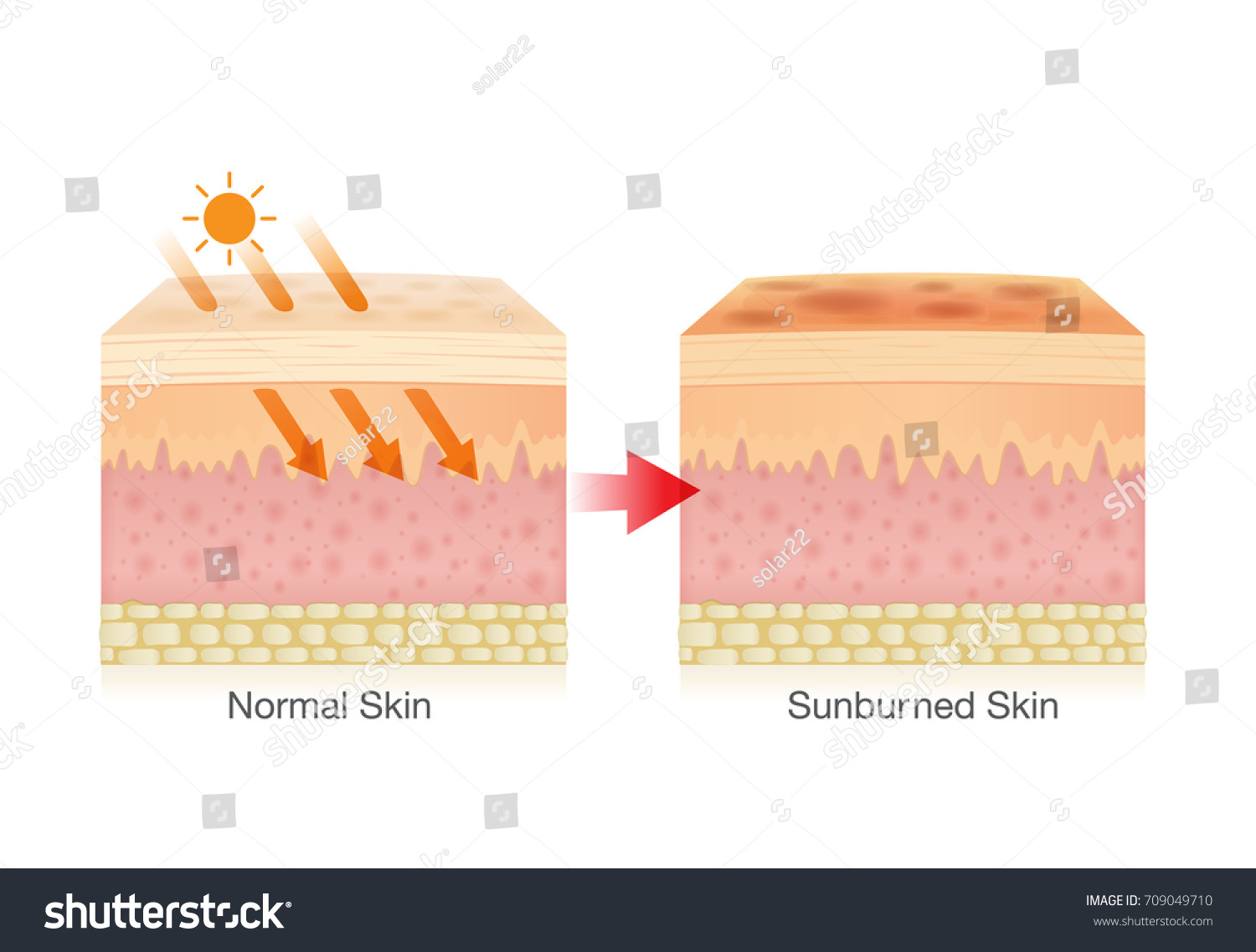 8,019 Skin uv rays Images, Stock Photos & Vectors | Shutterstock