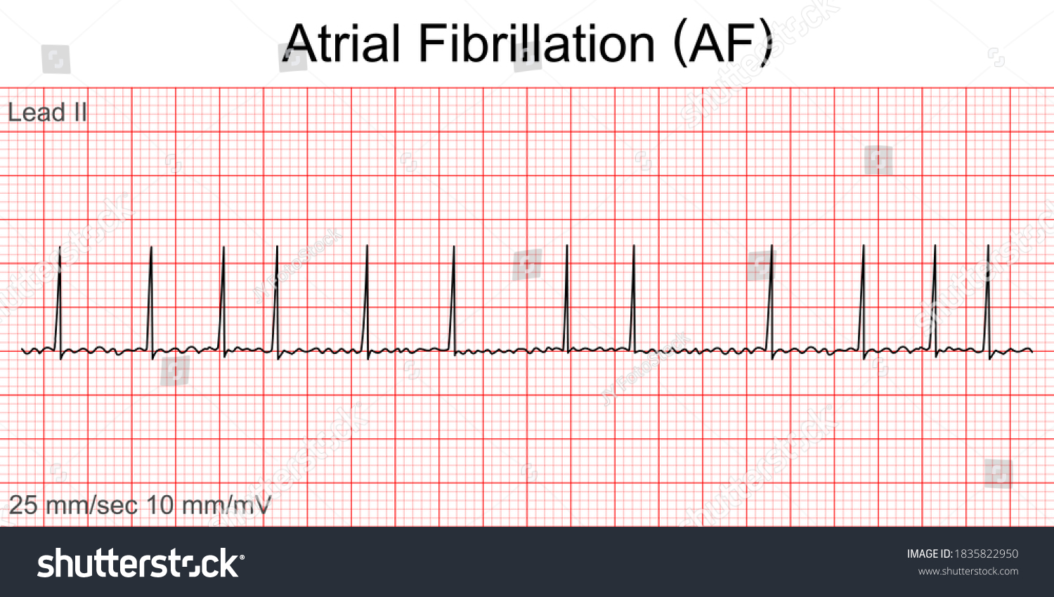 Ecg Atrial Fibrillation Images, Stock Photos & Vectors | Shutterstock