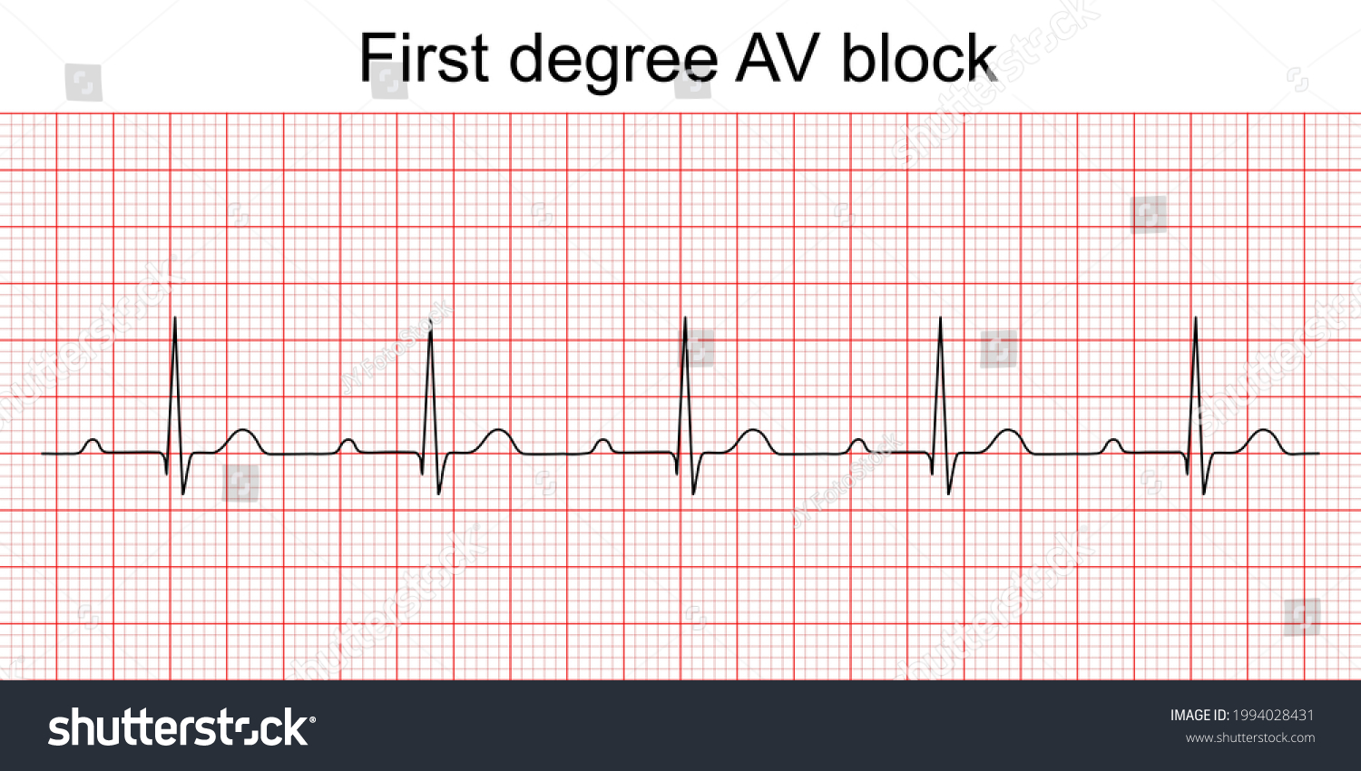 At with first degree av block Images, Stock Photos & Vectors | Shutterstock