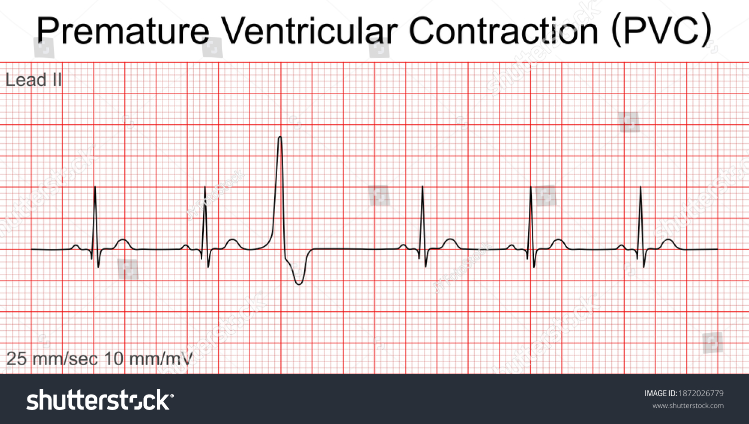 PVC EKG Image