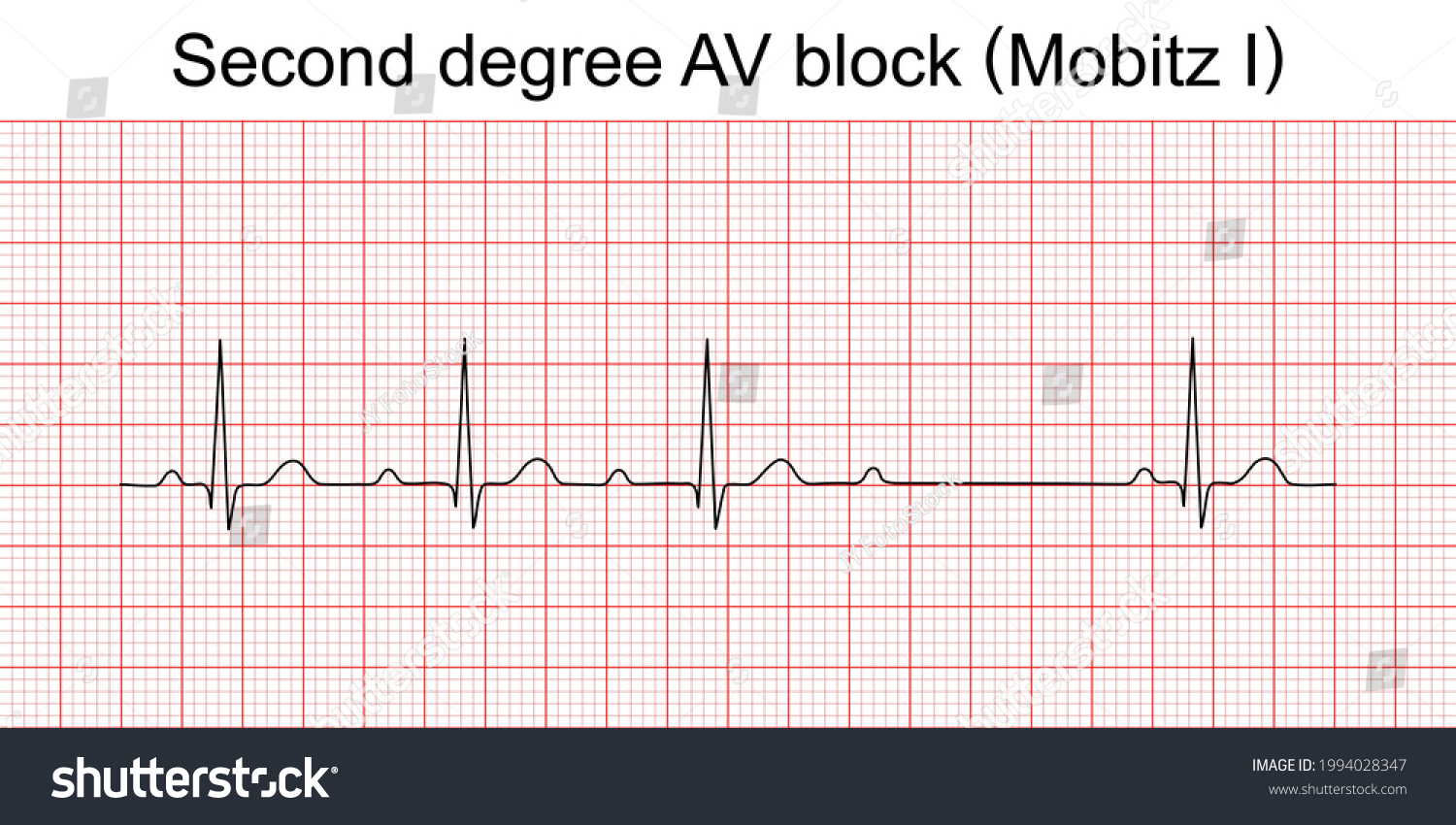 second-degree-av-block-8-images-photos-et-images-vectorielles-de