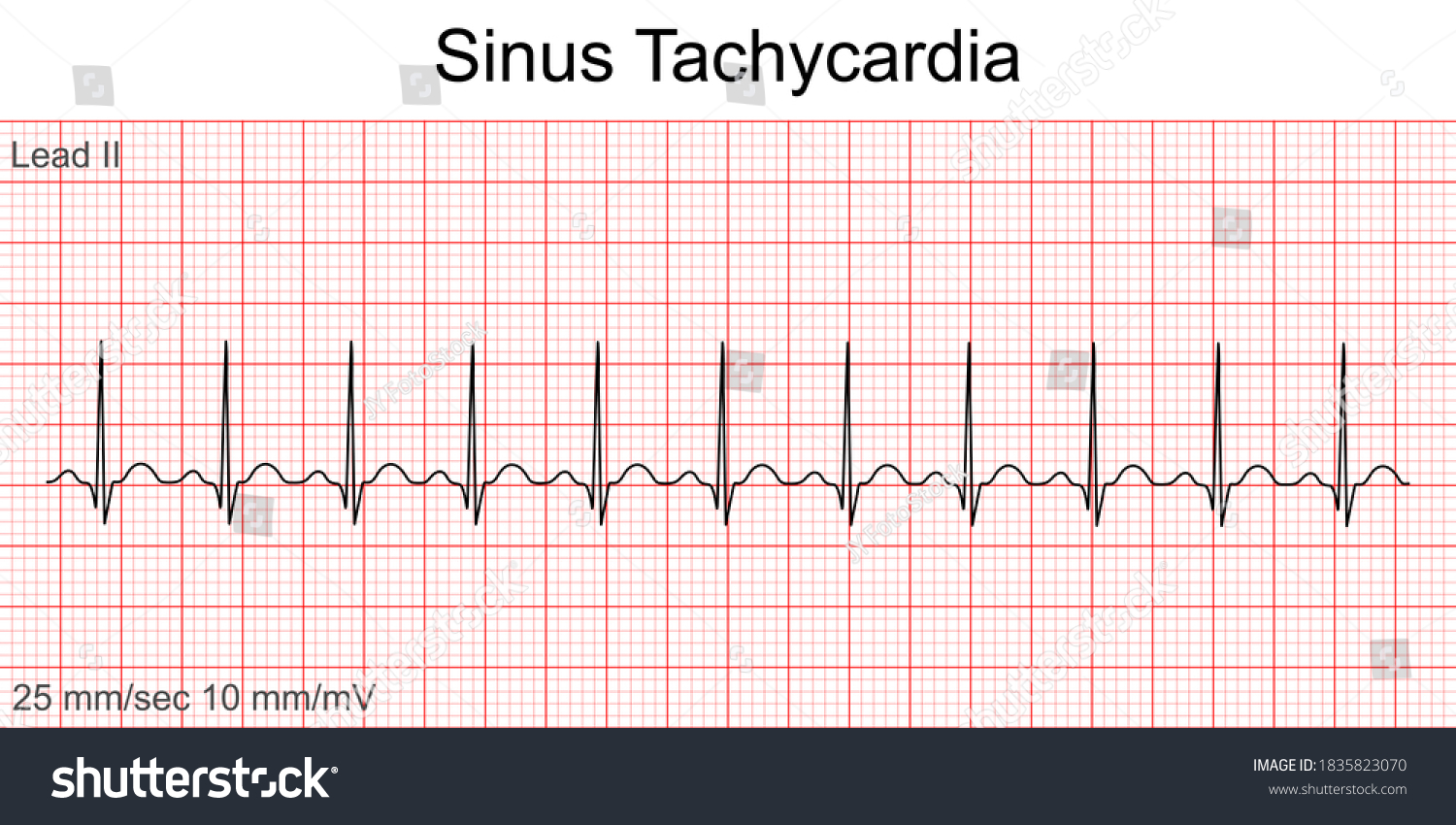 Tachycardia Stock Illustrations, Images & Vectors | Shutterstock