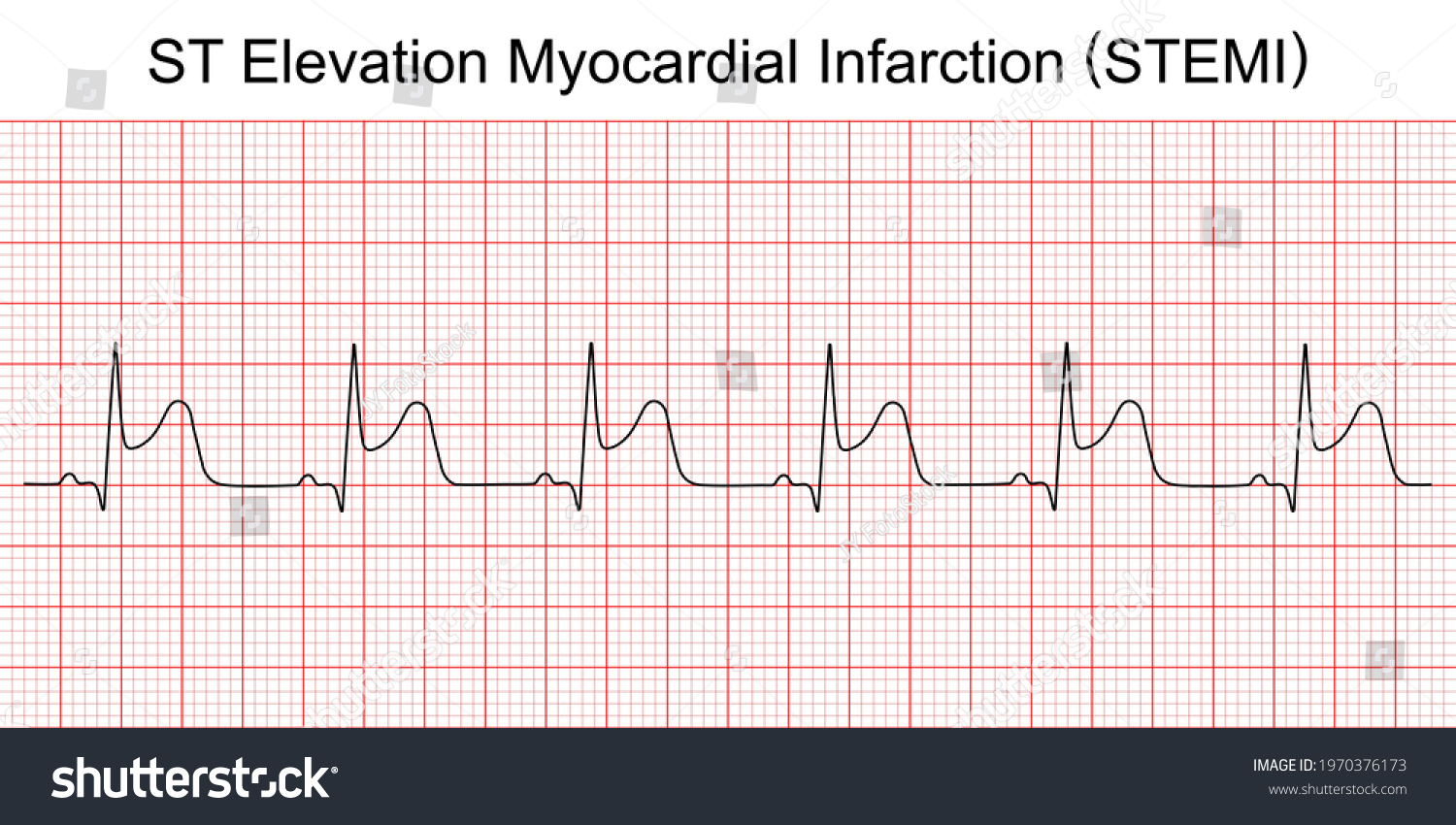 Electrocardiogram Show St Elevation Myocardial Infarction Stock Vector