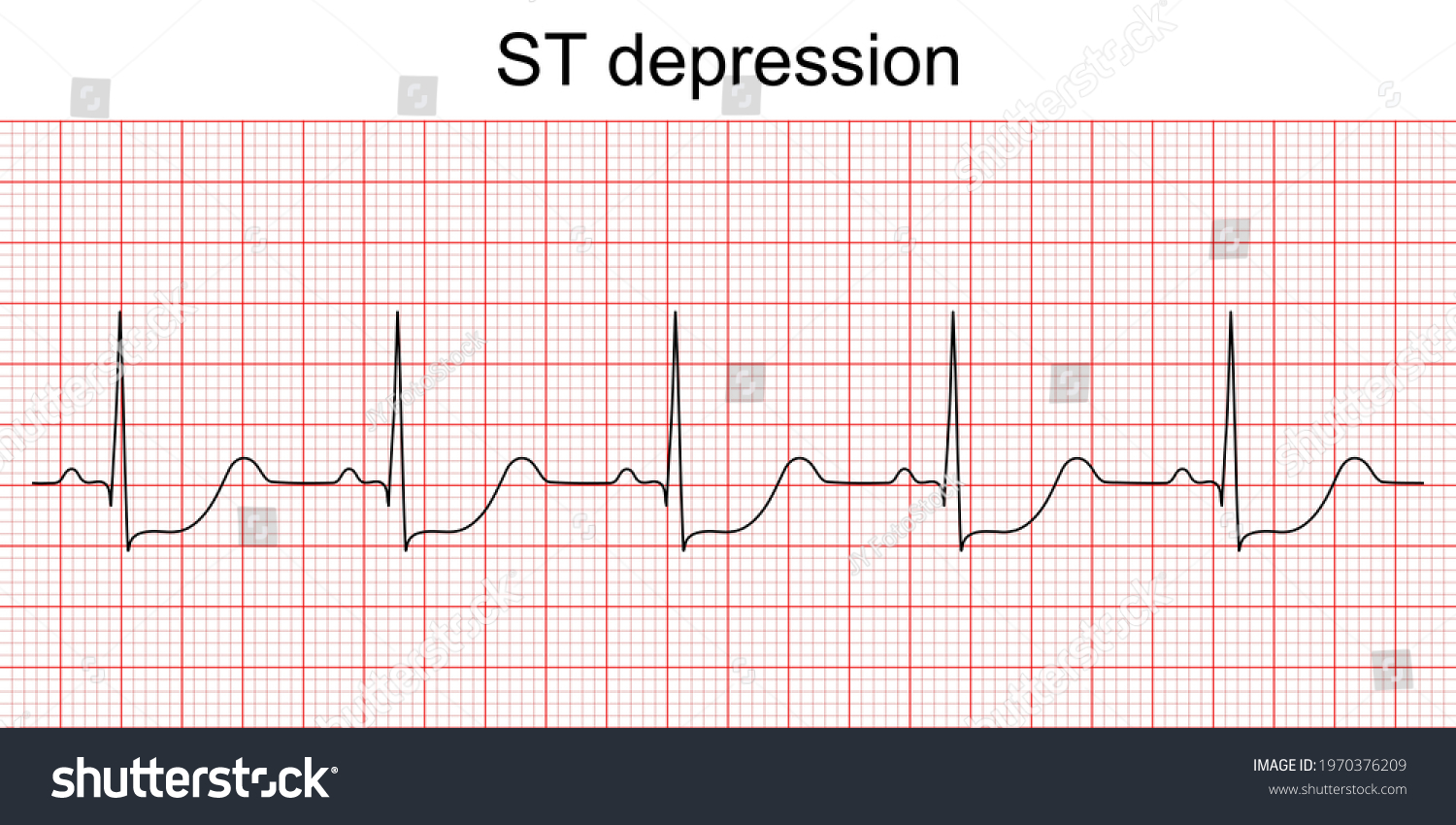 242 Myocardial depression Images, Stock Photos & Vectors | Shutterstock