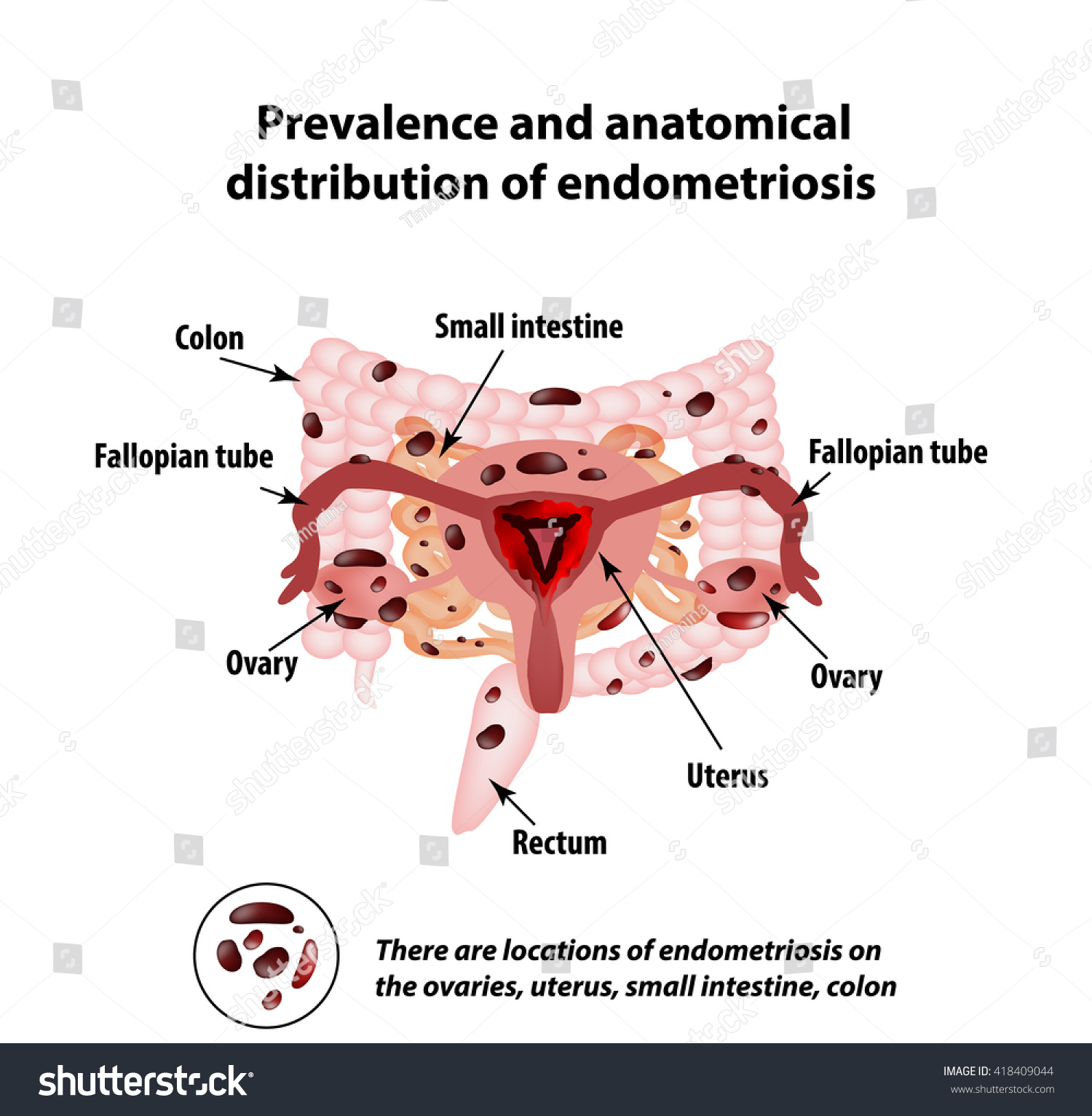 Endometriosis Appearance Disease Endometriosis Distribution Endometriosis Stock Vector 418409044 2320