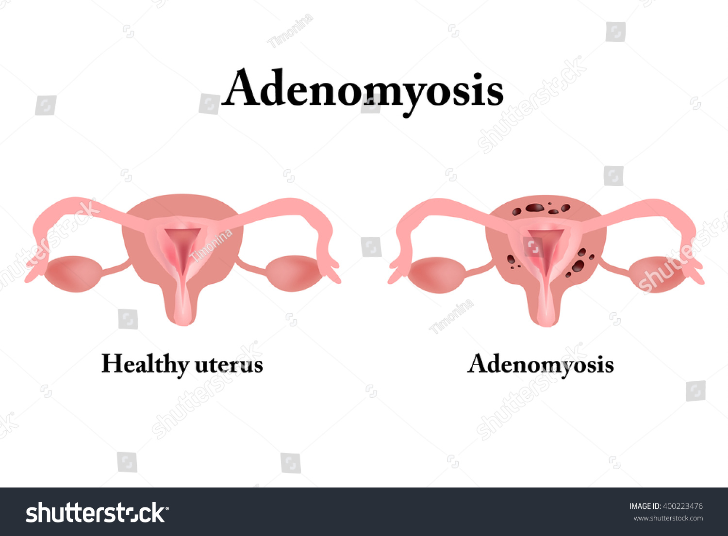 Endometriosis Structure Pelvic Organs Adenomyosis Endometrium Stock Vector 400223476 Shutterstock 9574