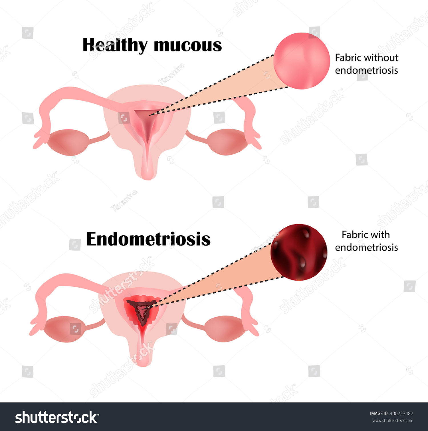 Endometriosis Structure Pelvic Organs Adenomyosis Endometrium Stock Vector Royalty Free 400223482