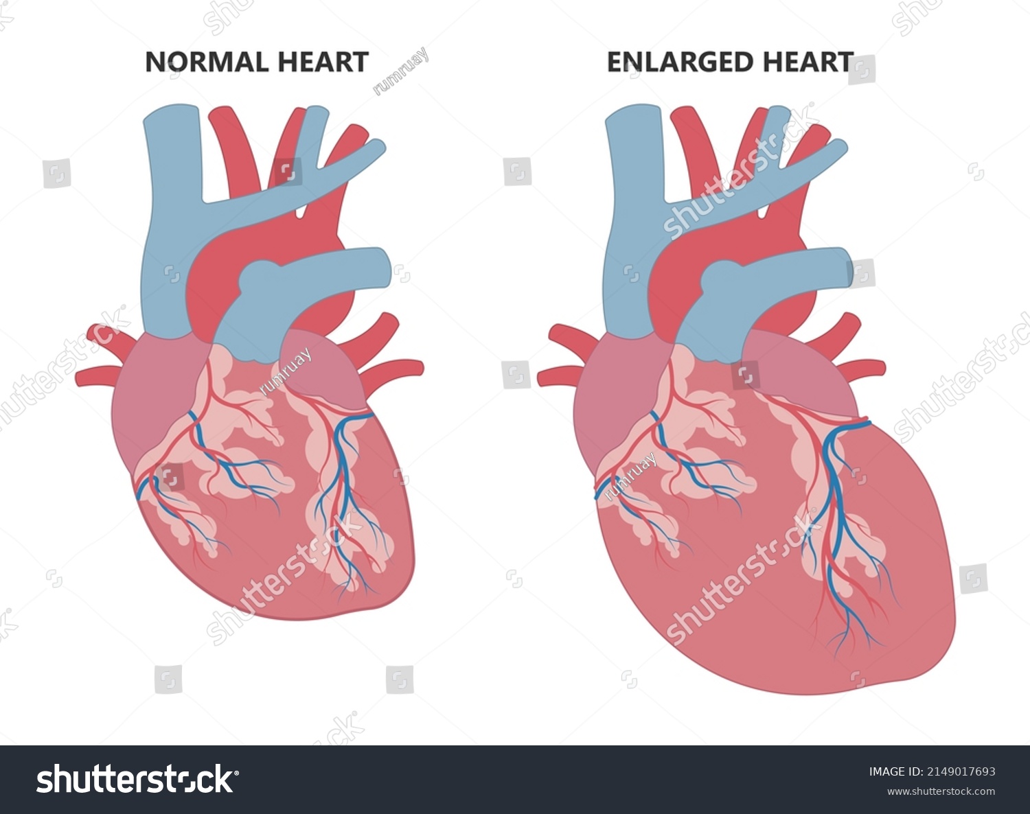 Enlarged Athletes Heart Angina Xray Edema Stock Vector (Royalty Free ...