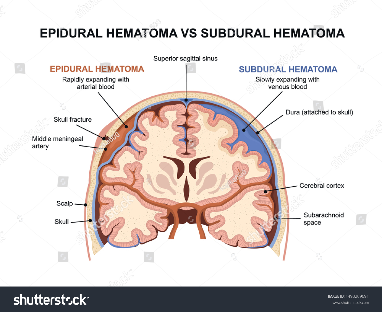 Vs hematoma epidural hematoma subdural Subdural hematoma
