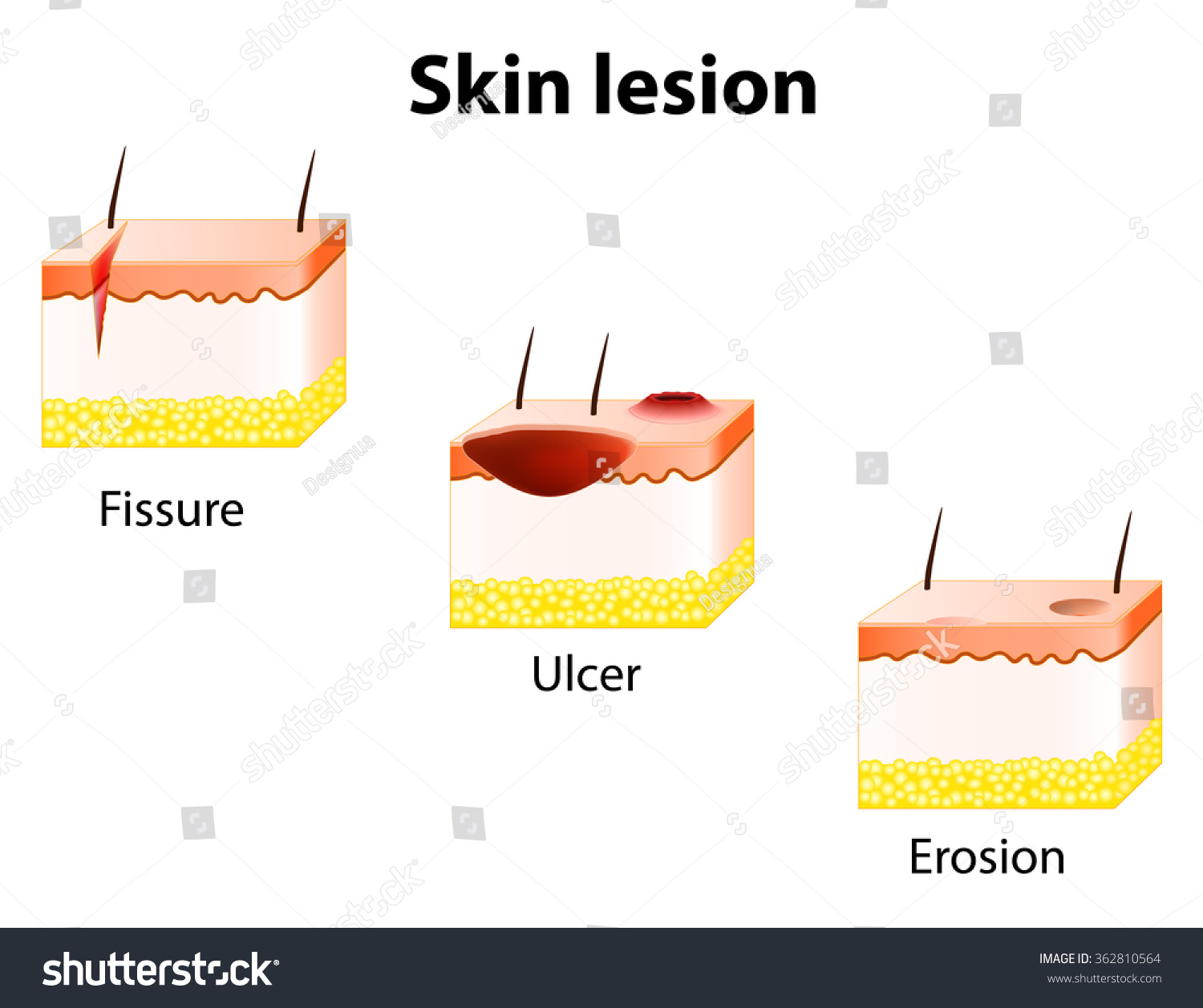 Erosion, Ulcer And Fissure. Skin Lesion. Stock Vector Illustration ...