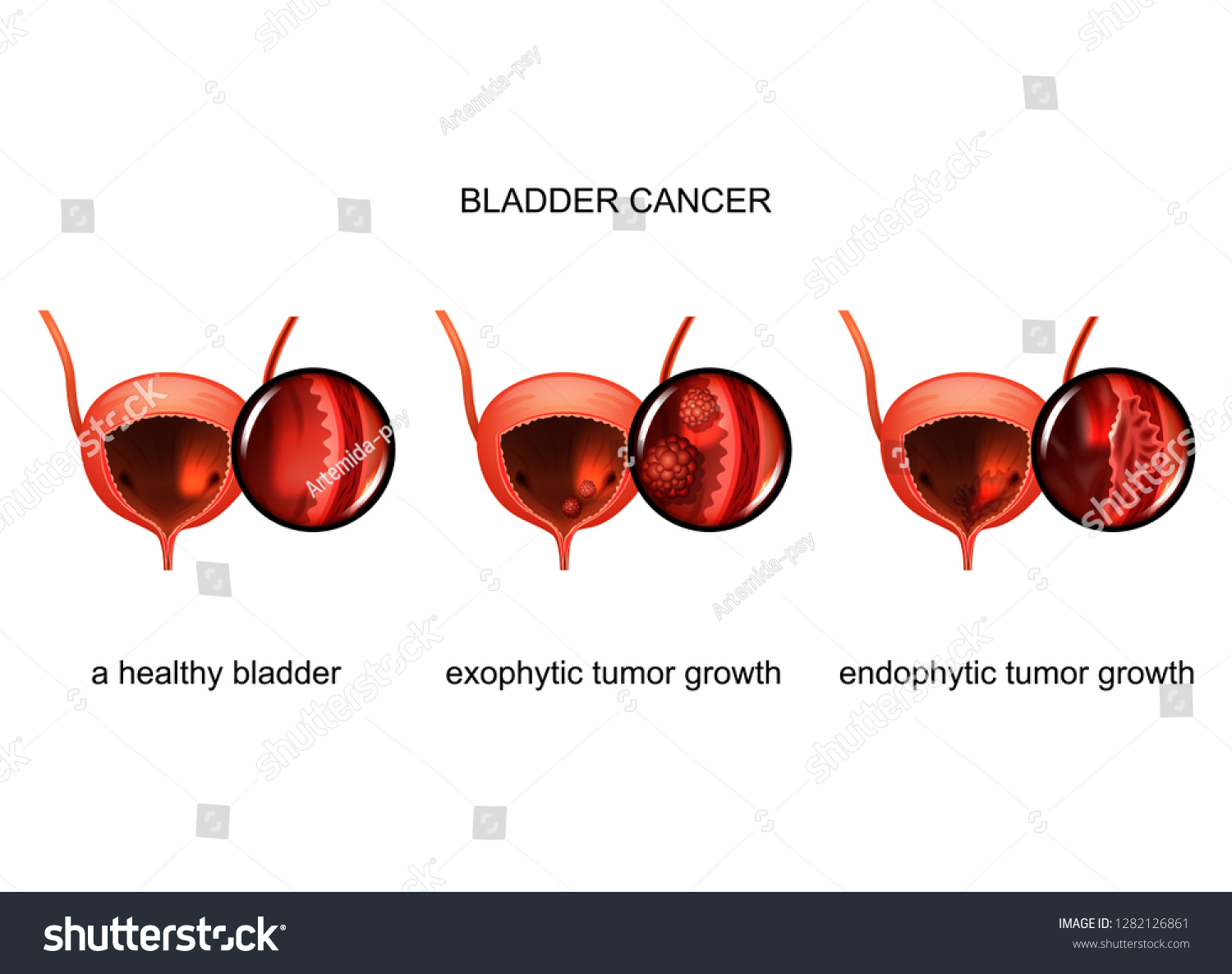 Exophytic Endophytic Growth Cancer Bladder Stock Vector Royalty Free 1282126861