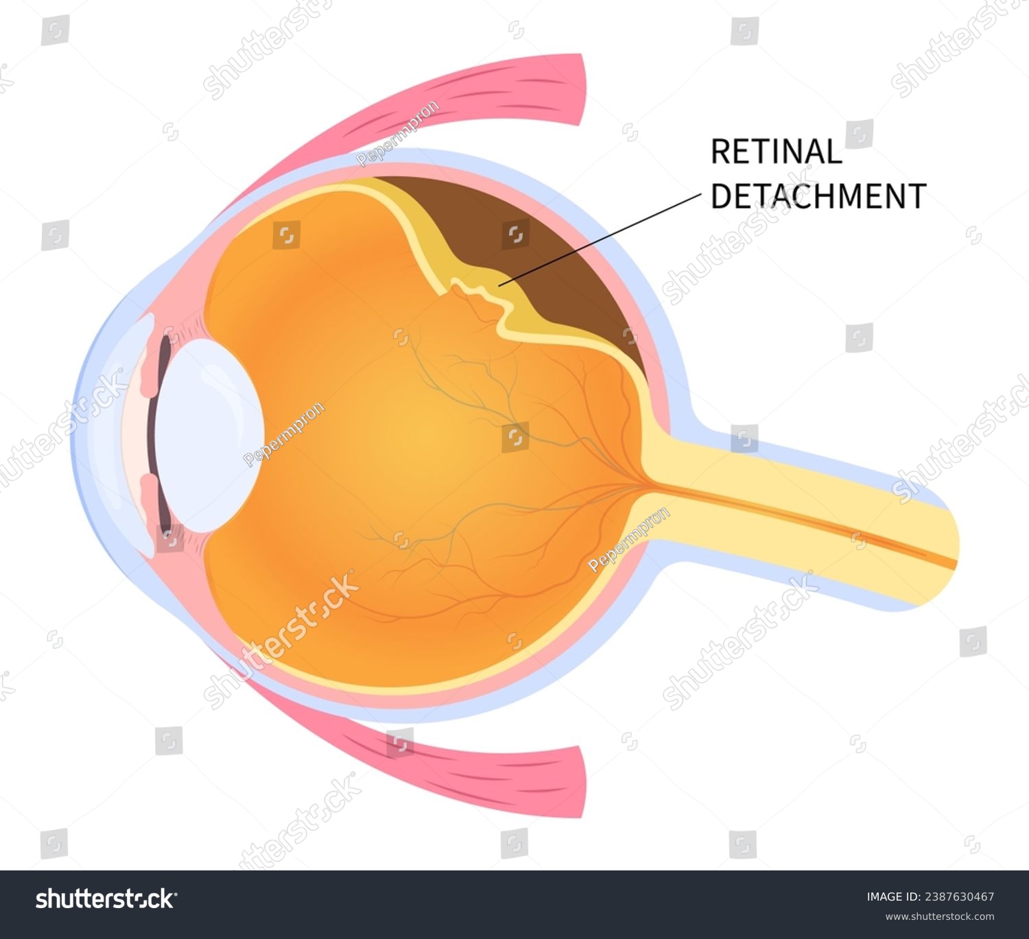SVG of Eye blurred vision loss with floaters Myopia and detached retina after trauma injury of macular hole that tear or torn which lead to pain in nearsighted svg