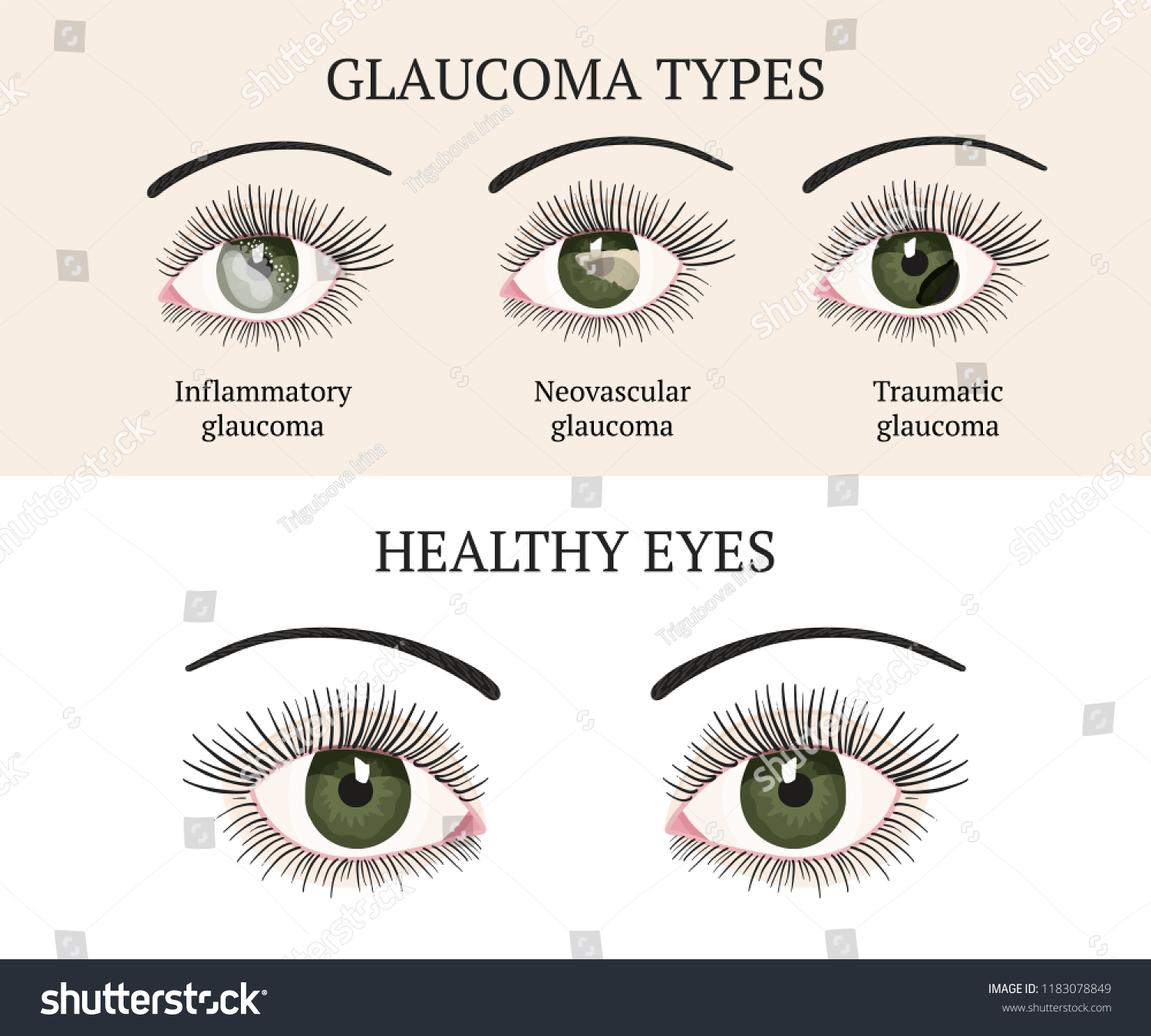 Eye Disease Ophthalmology Health Glaucoma Types Stock Vector (Royalty ...