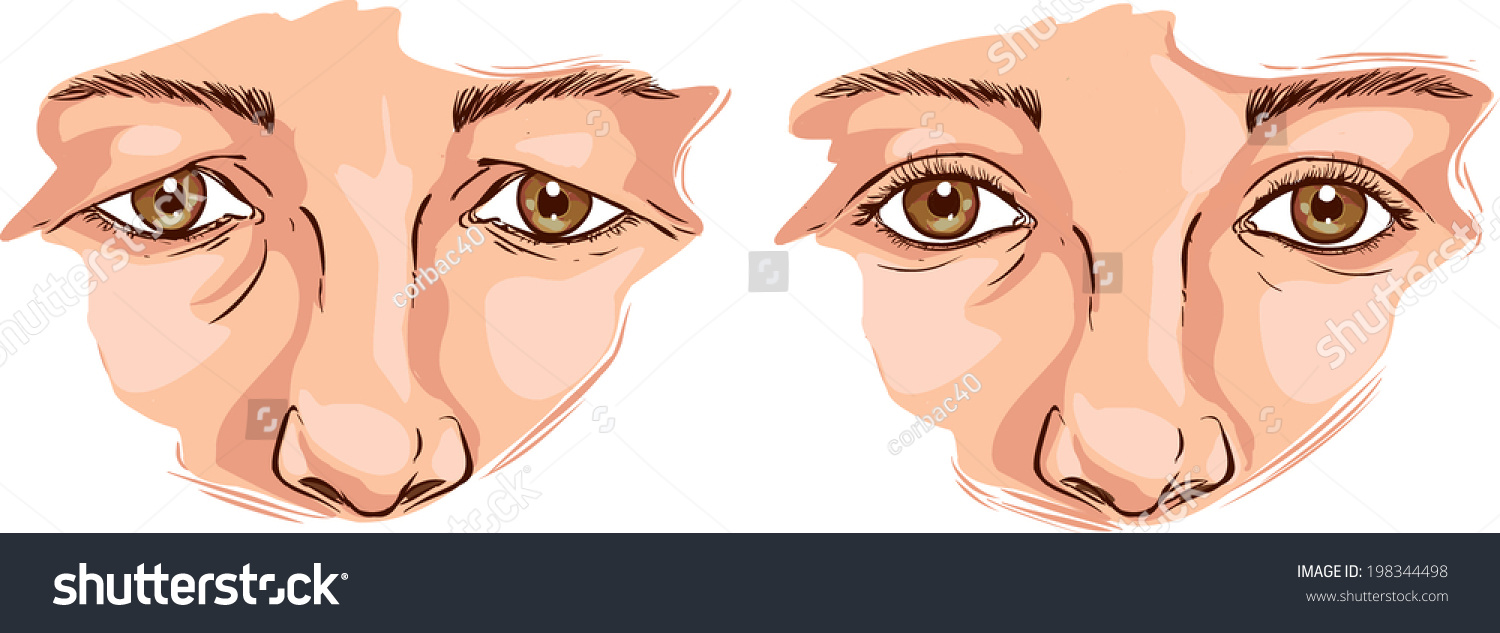Eyelid Lift Stock Vector (Royalty Free) 198344498 | Shutterstock