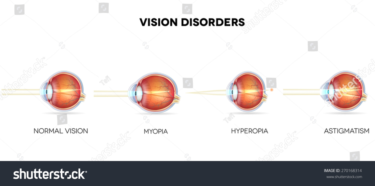 Myopia Vs Hyperopia Vs Astigmatism Astigmatism Glaucoma