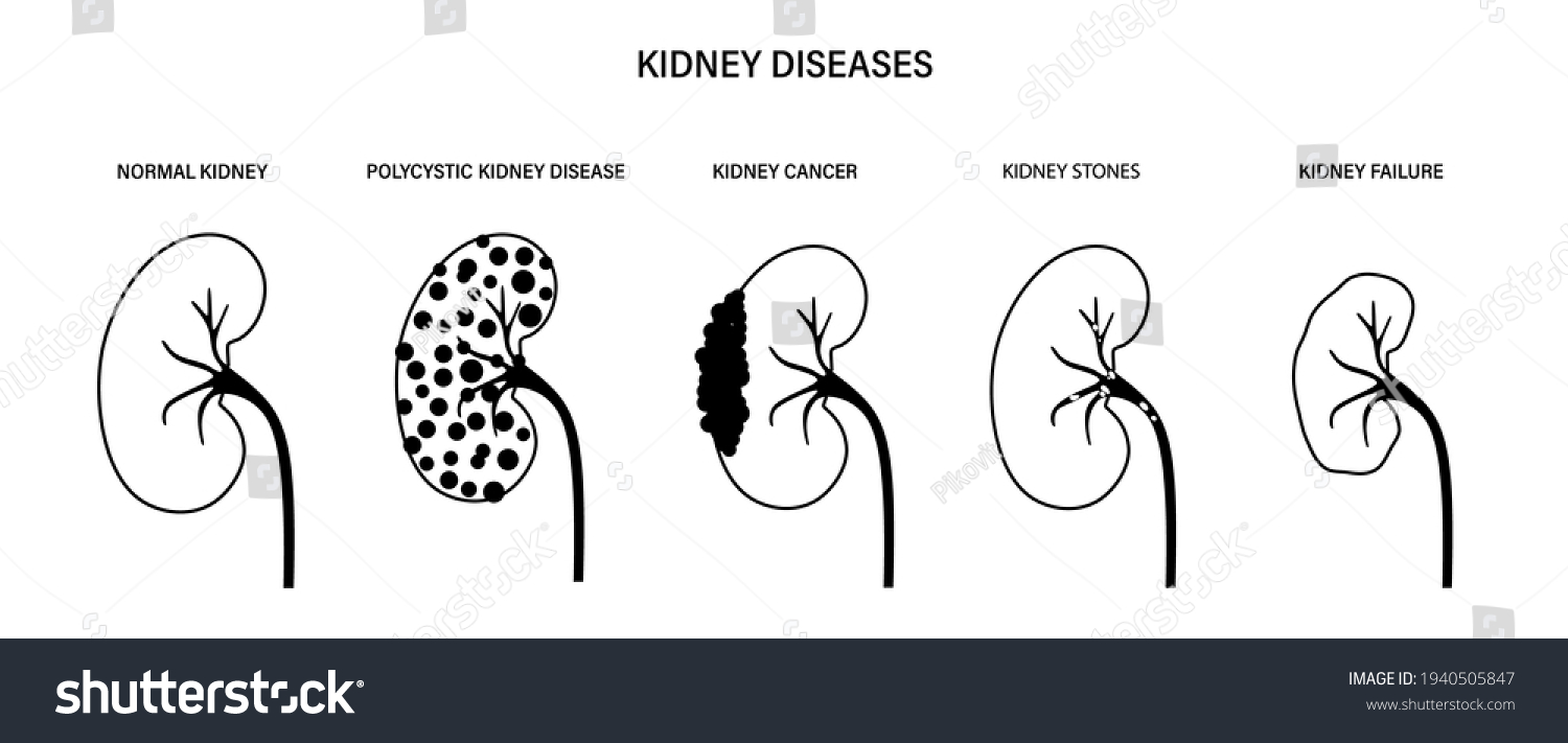 Failure Stone Cancer Polycystic Pyelonephritis Icons Stock Vector ...