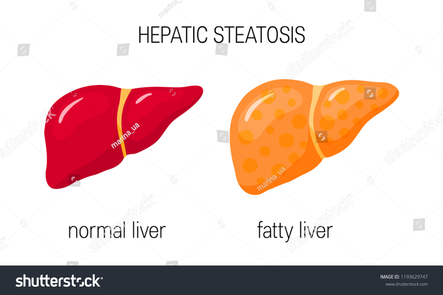 Fatty Liver Disease Vector Illustration Healthy Vetor Stock Livre De Direitos 1193629747