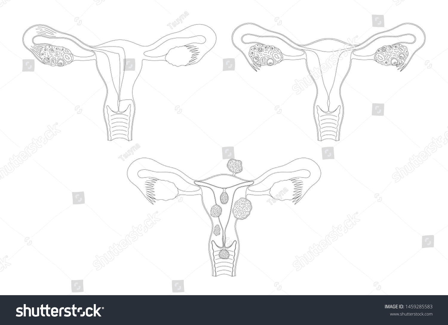 Vektor Stok Female Reproductive System Healthy Sick Vector Tanpa Royalti 1459285583 Shutterstock 8527