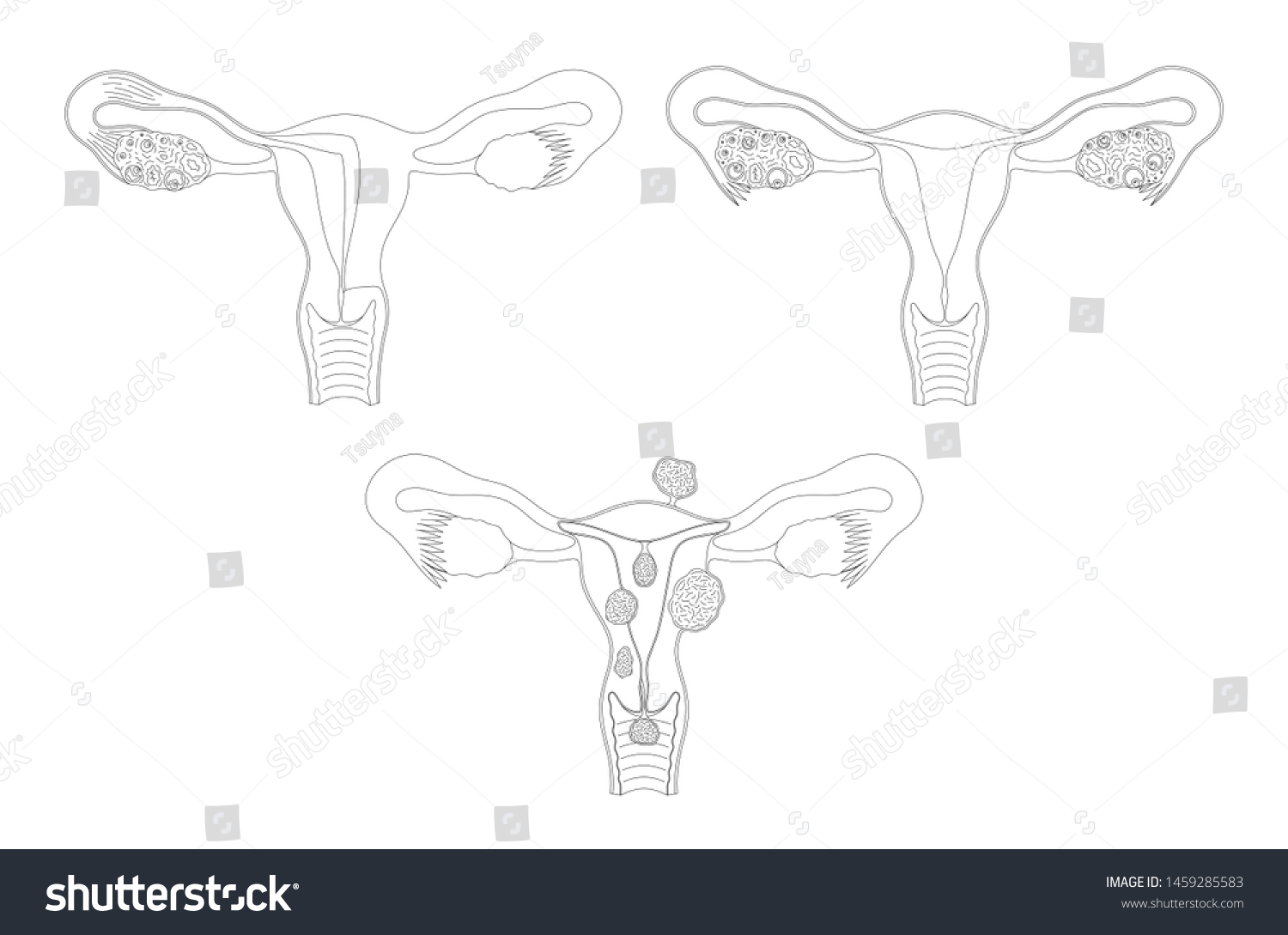 Vektor Stok Female Reproductive System Healthy Sick Vector Tanpa Royalti 1459285583 Shutterstock 8286